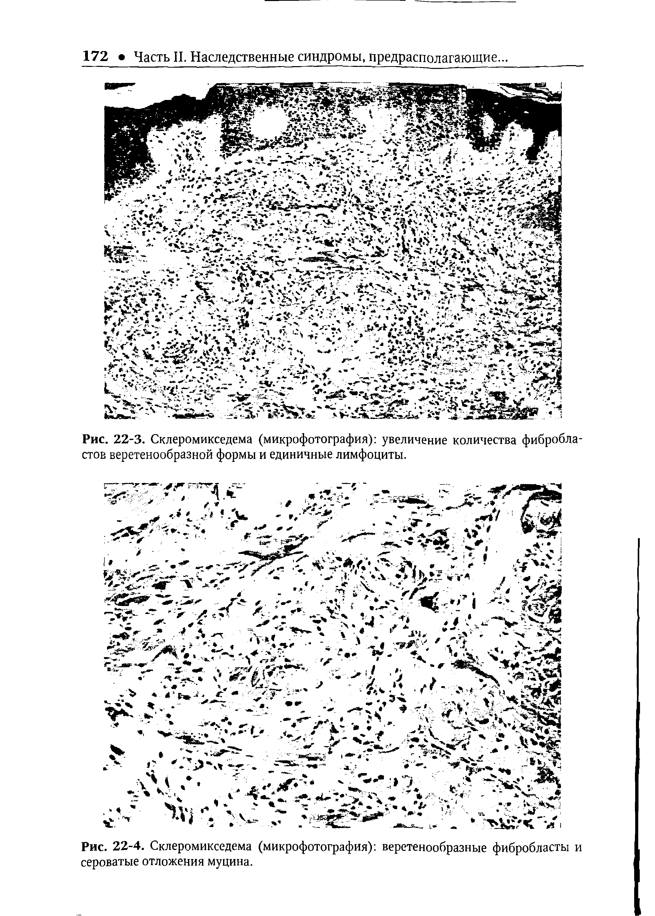 Рис. 22-3. Склеромикседема (микрофотография) увеличение количества фибробластов веретенообразной формы и единичные лимфоциты.