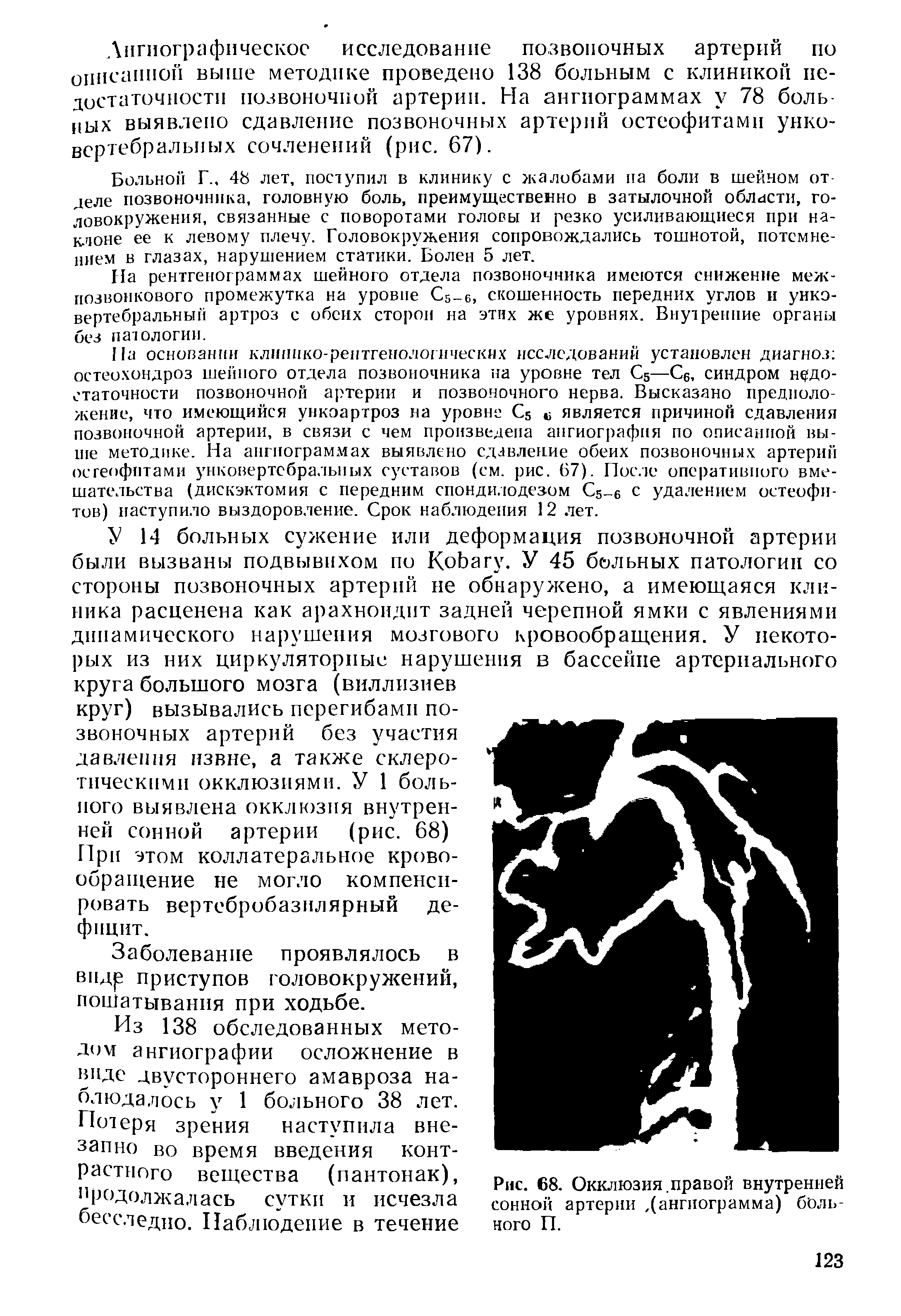 Рис. 68. Окклюзия.правой внутренней сонной артерии, (ангиограмма) больного П.