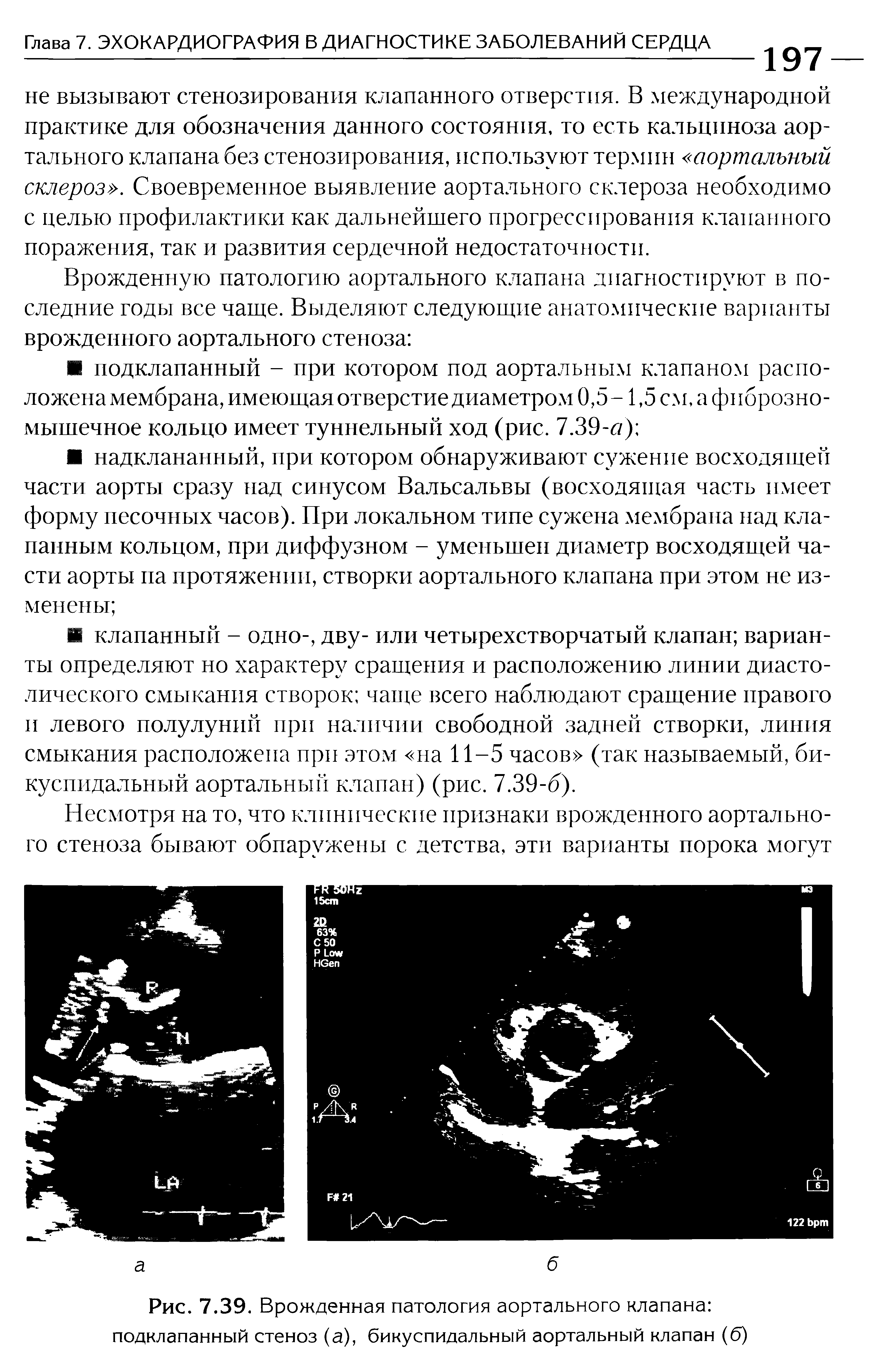 Рис. 7.39. Врожденная патология аортального клапана подклапанный стеноз (а), бикуспидальный аортальный клапан (б)...