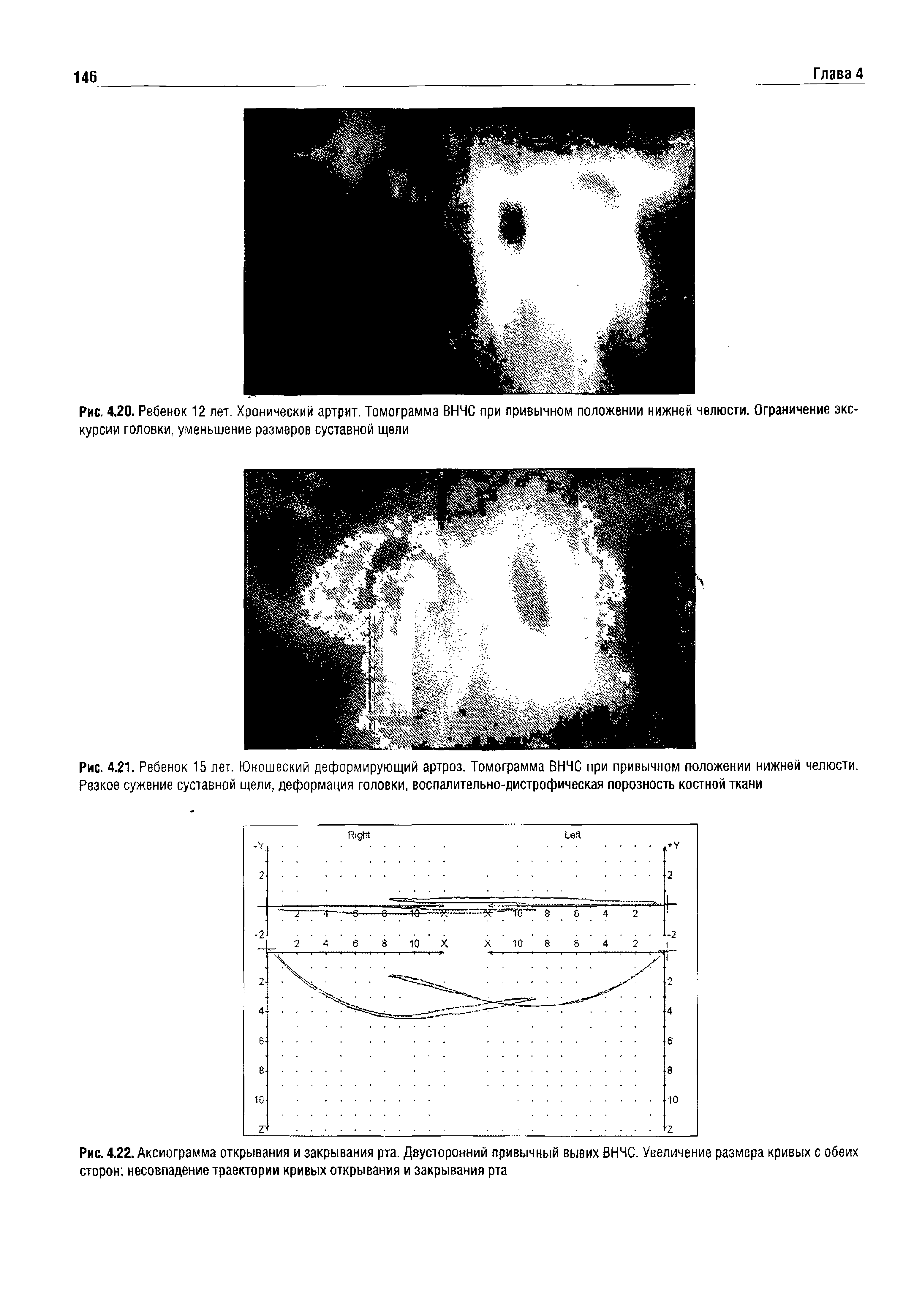Рис. 4.20. Ребенок 12 лет. Хронический артрит. Томограмма ВНЧС при привычном положении нижней челюсти. Ограничение экскурсии головки, уменьшение размеров суставной щели...