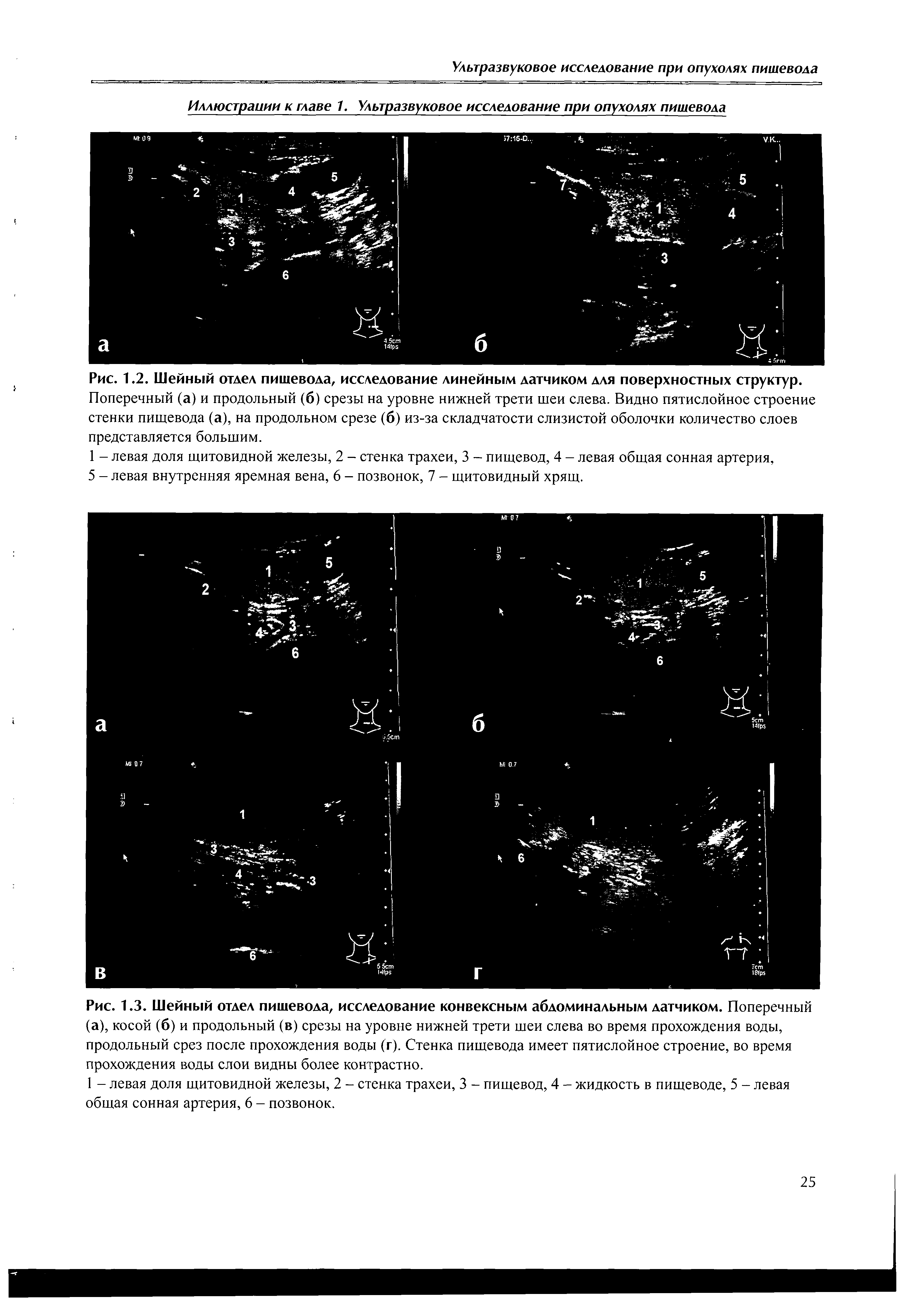 Рис. 1.3. Шейный отдел пищевода, исследование конвексным абдоминальным датчиком. Поперечный...