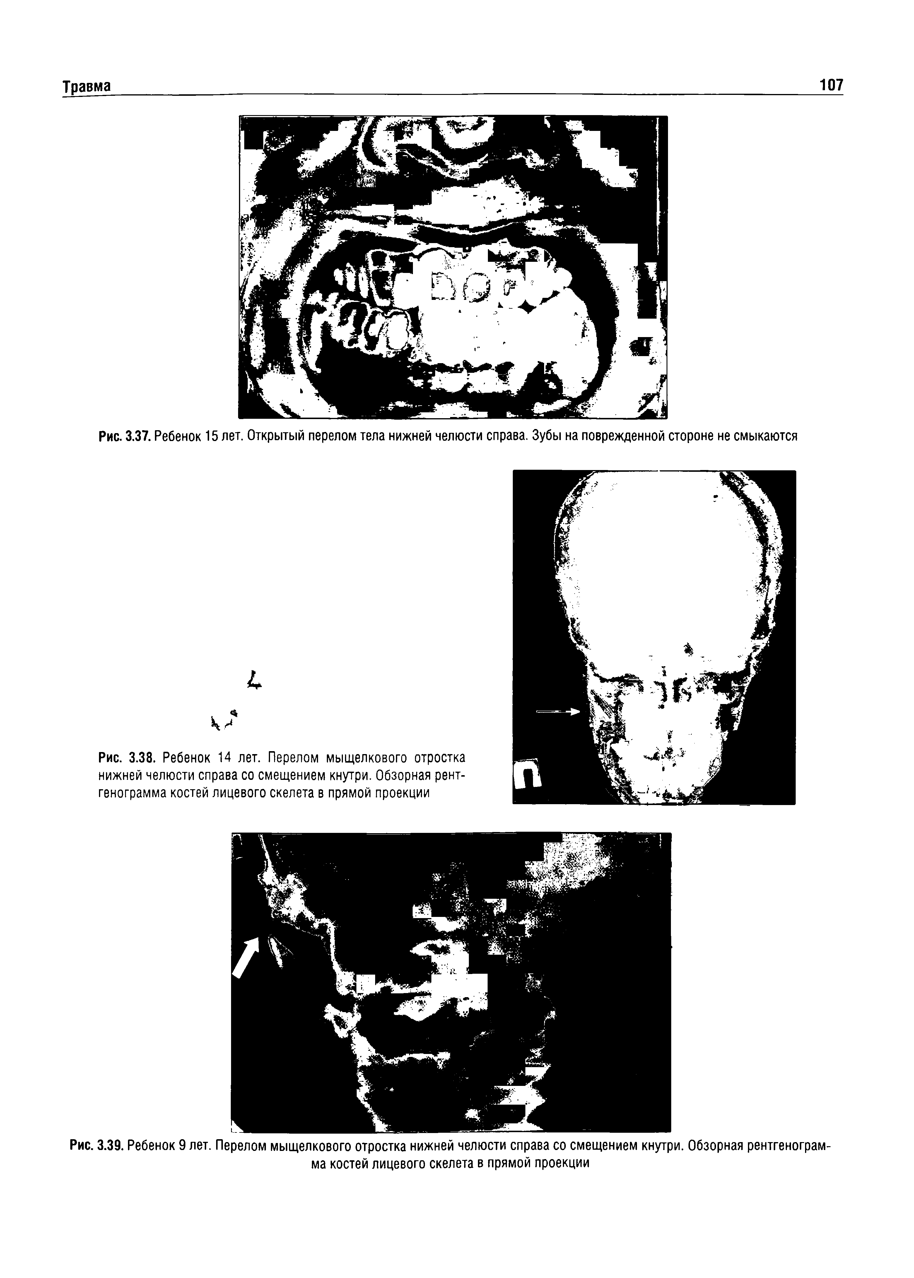 Рис. 3.37. Ребенок 15 лет. Открытый перелом тела нижней челюсти справа. Зубы на поврежденной стороне не смыкаются...