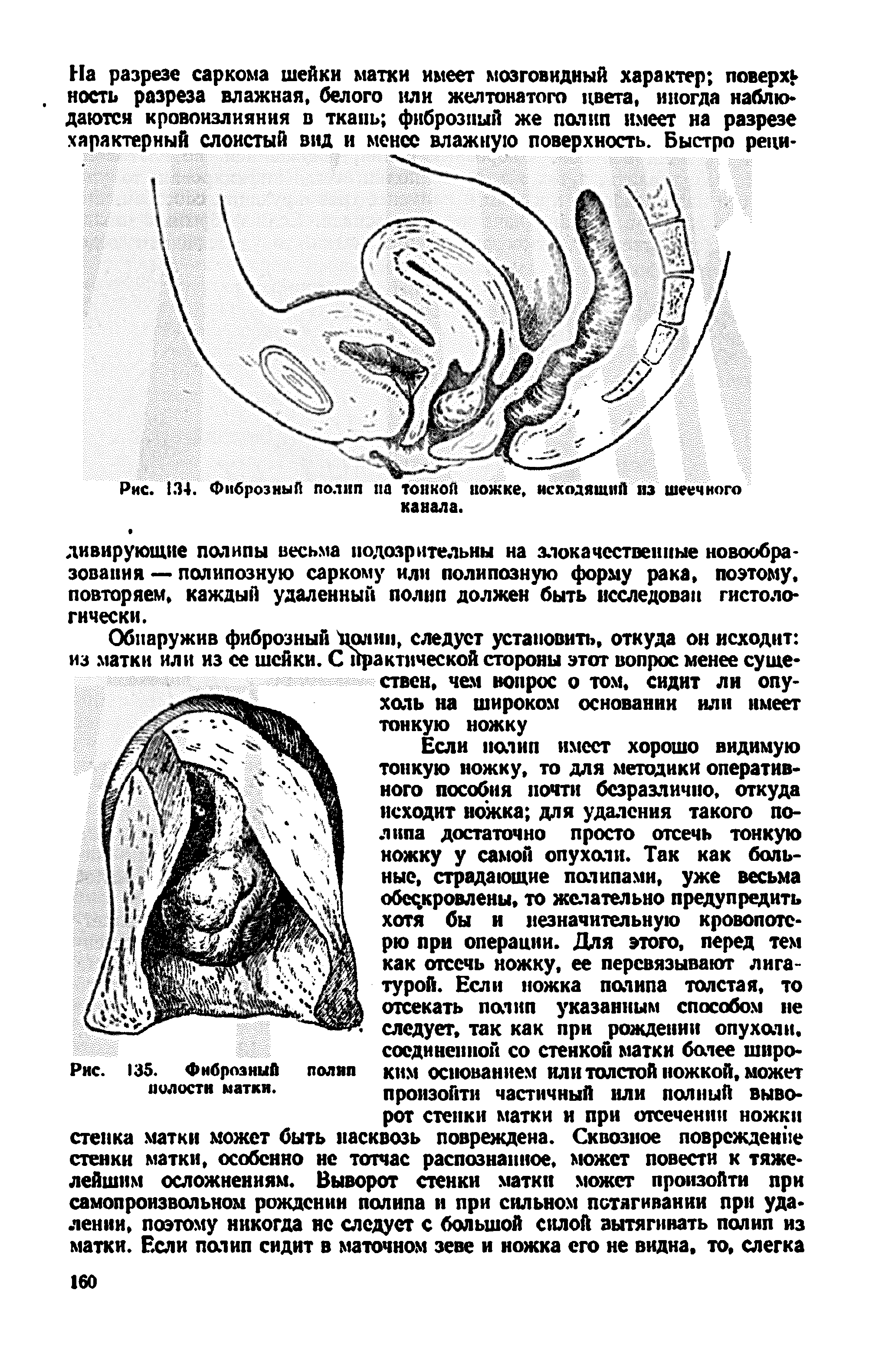 Рис. 135. Фиброзный полип ким основанием или толстой ножкой, может полости матки. произойти частичный или полный выво-...
