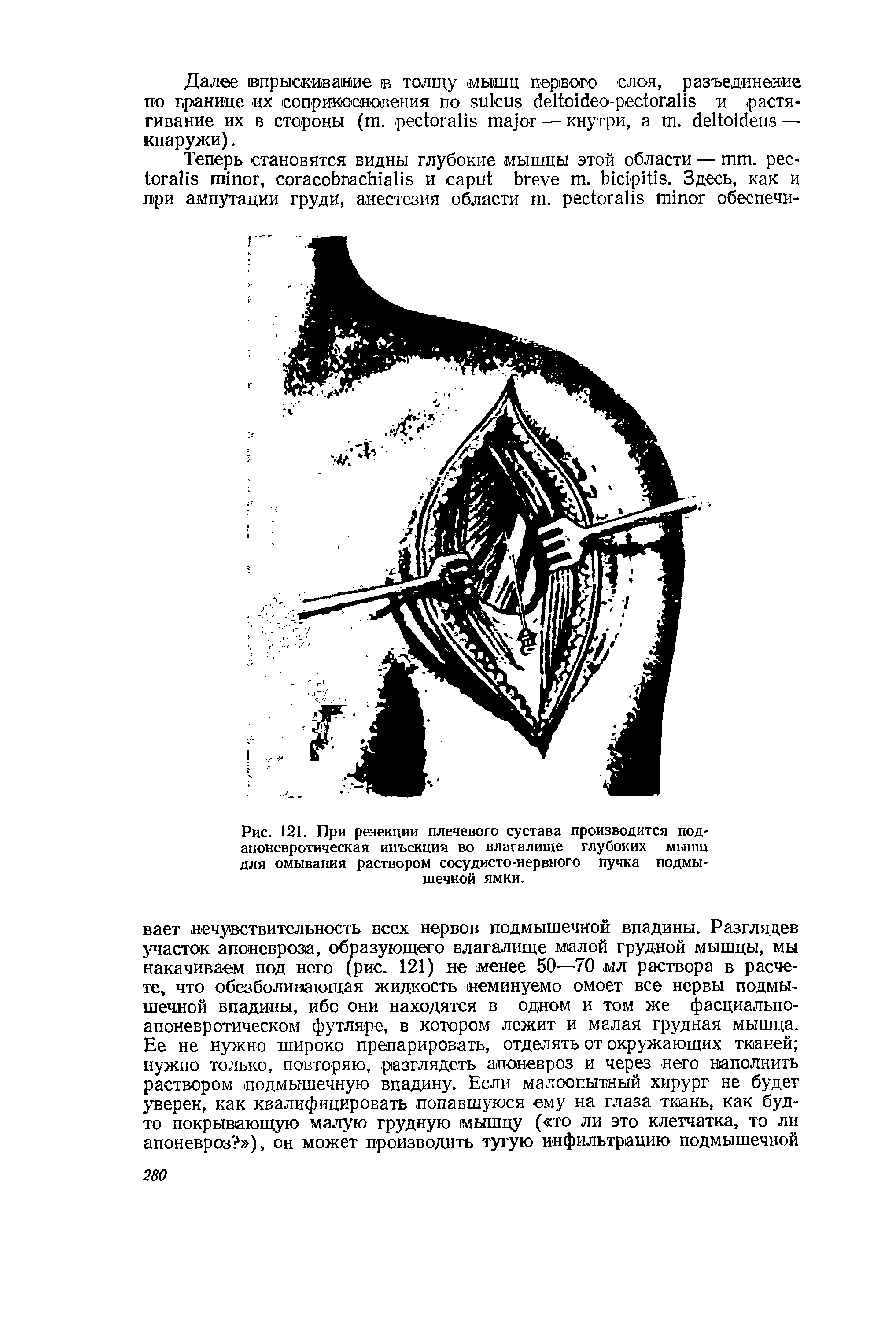 Рис. 121. При резекции плечевого сустава производится подапоневротическая инъекция во влагалище глубоких мышц для омывания раствором сосудисто-нервного пучка подмышечной ямки.