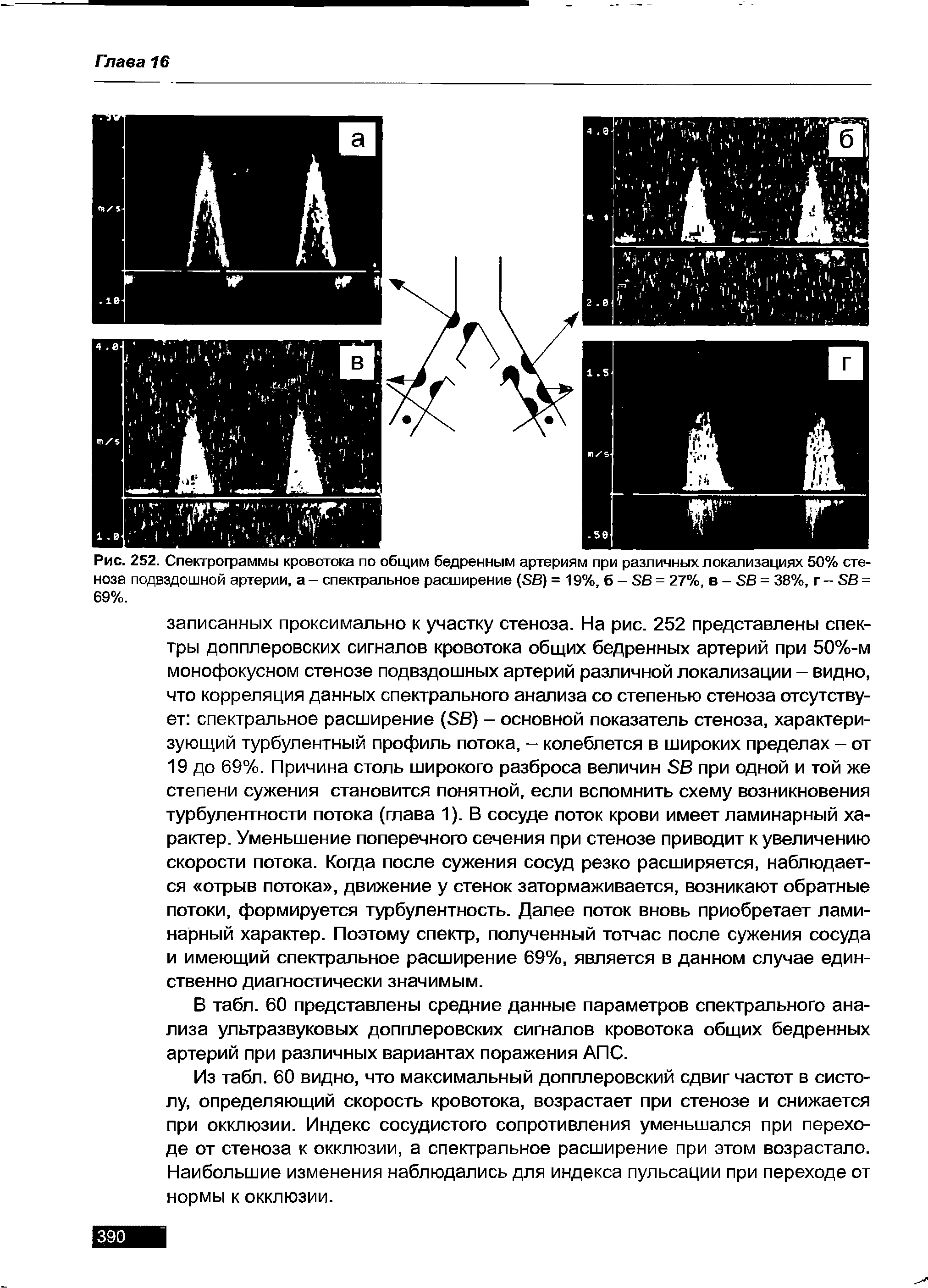 Рис. 252. Спектрограммы кровотока по общим бедренным артериям при различных локализациях 50% стеноза подвздошной артерии, а - спектральное расширение (БВ) = 19%, б- БВ- 27%, в - БВ = 38%, г - БВ = 69%.