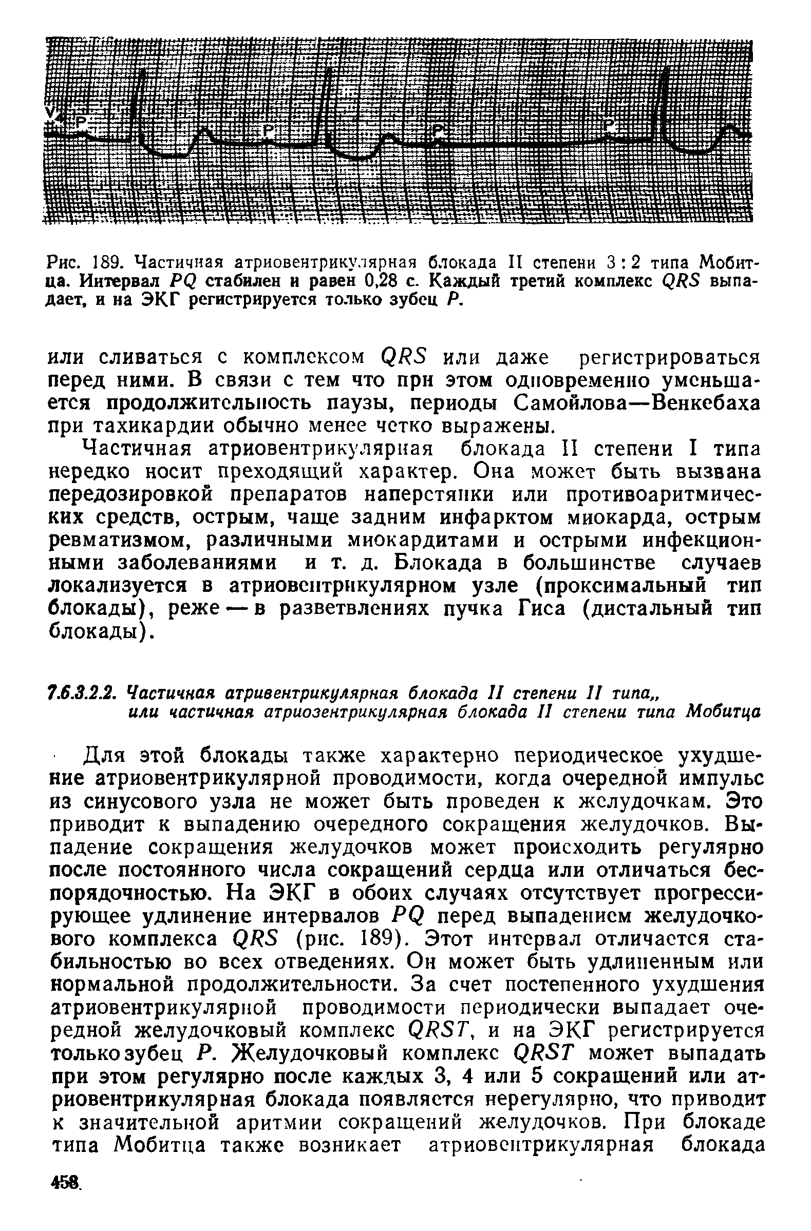 Рис. 189. Частичная атриовентрикулярная блокада II степени 3 2 типа Мобитца. Интервал Р<2 стабилен и равен 0,28 с. Каждый третий комплекс <2118 выпадает, и на ЭКГ регистрируется только зубец Р.