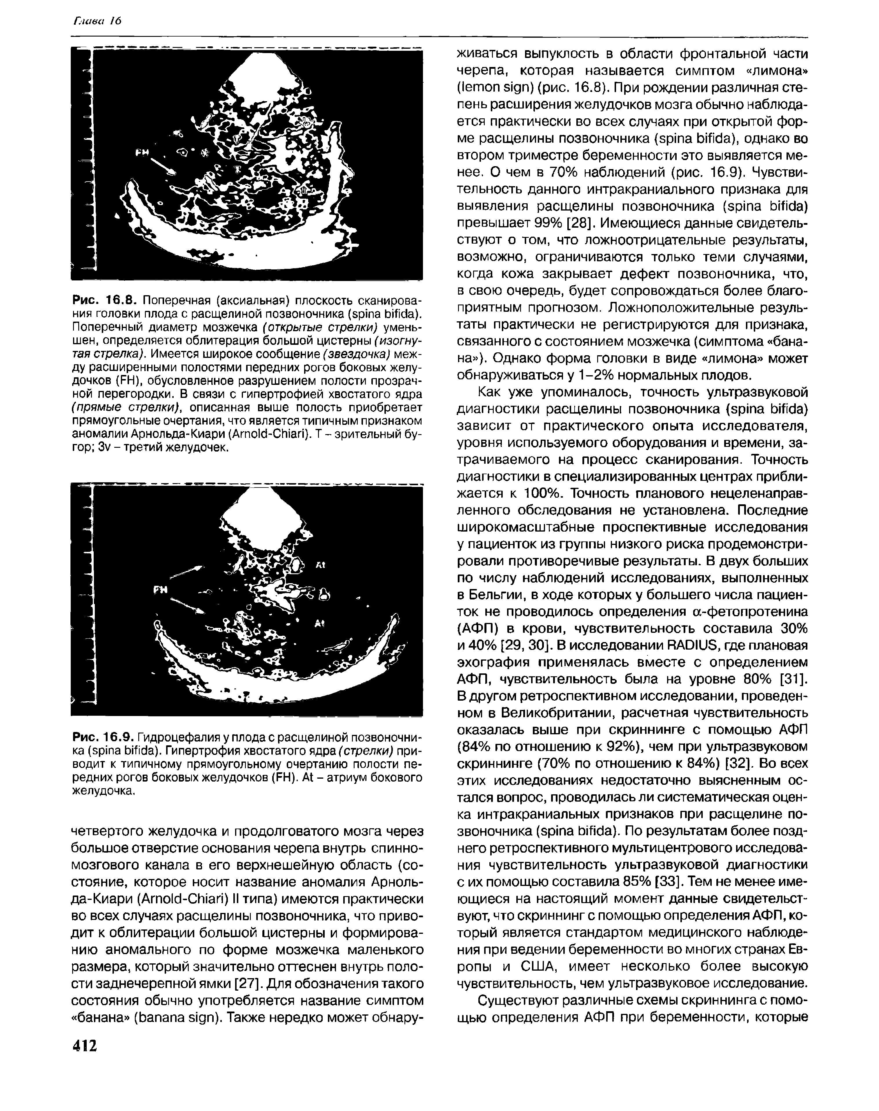 Рис. 16.9. Гидроцефалия у плода с расщелиной позвоночника ( ). Гипертрофия хвостатого ядра (стрелки) приводит к типичному прямоугольному очертанию полости передних рогов боковых желудочков (FH). A - атриум бокового желудочка.