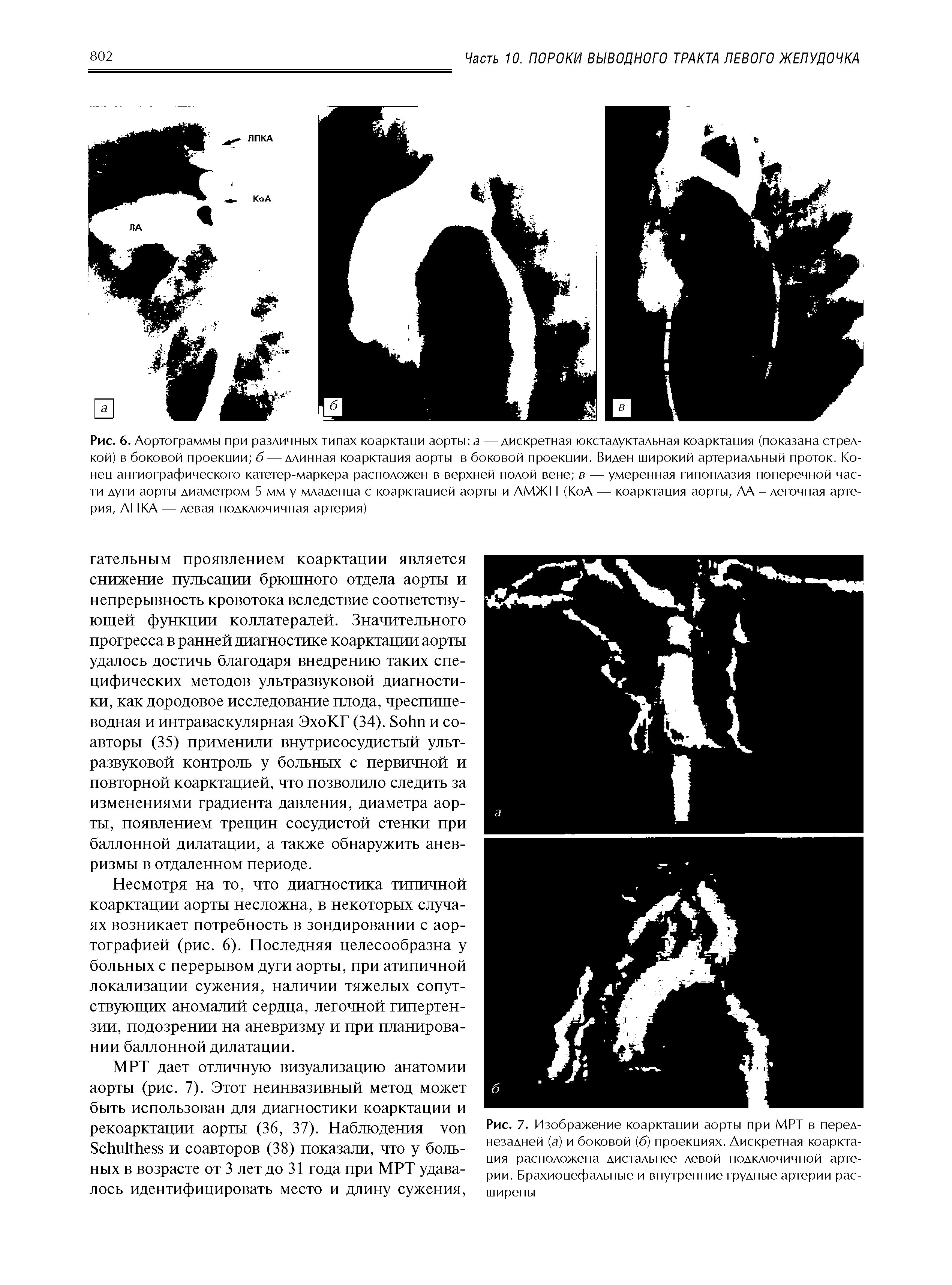 Рис. 7. Изображение коарктации аорты при МРТ в переднезадней (а) и боковой (б) проекциях. Дискретная коарктация расположена дистальнее левой подключичной артерии. Брахиоцефальные и внутренние грудные артерии расширены...