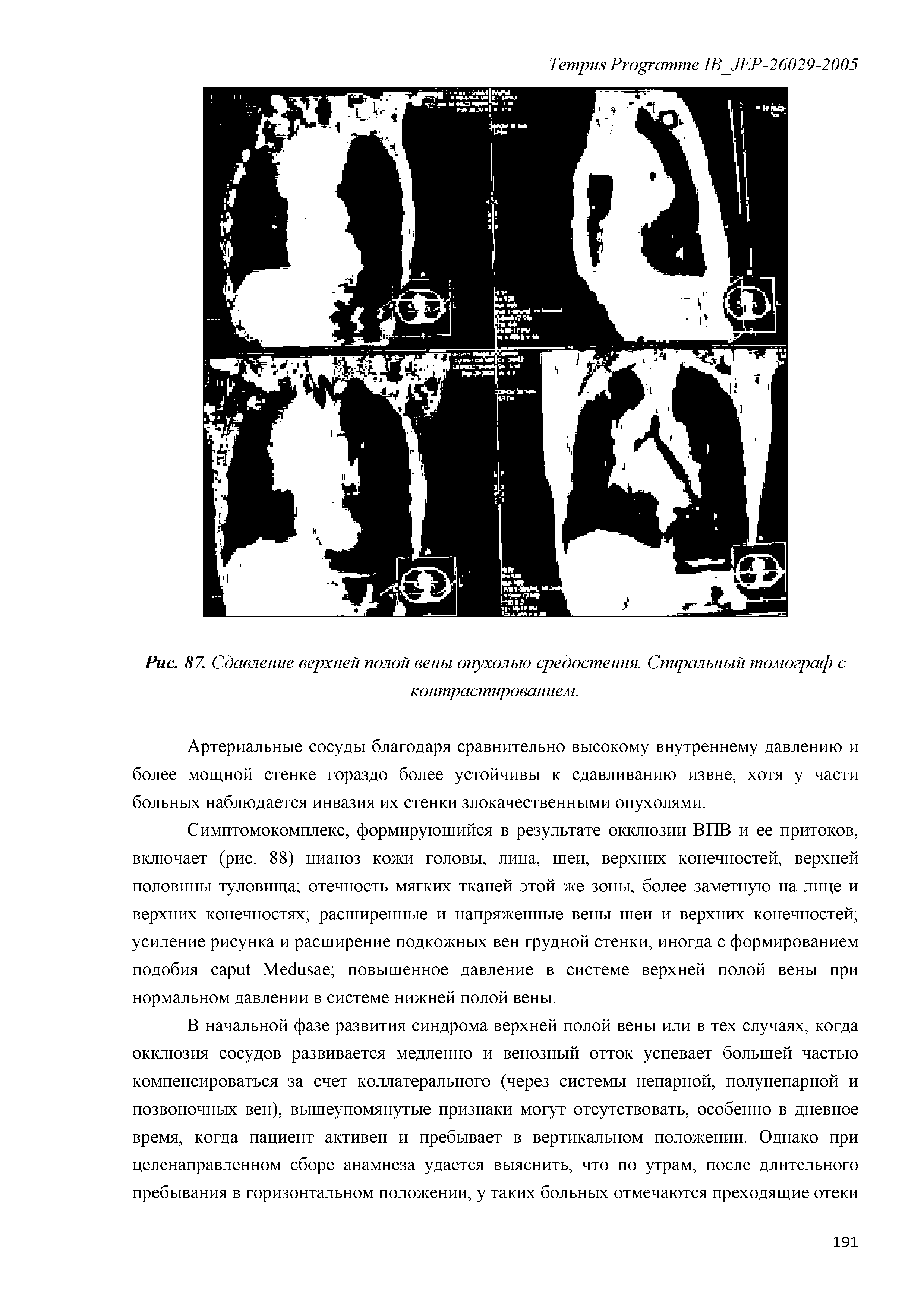 Рис. 87. Сдавление верхней полой вены опухолью средостения. Спиральный томограф с контрастированием.