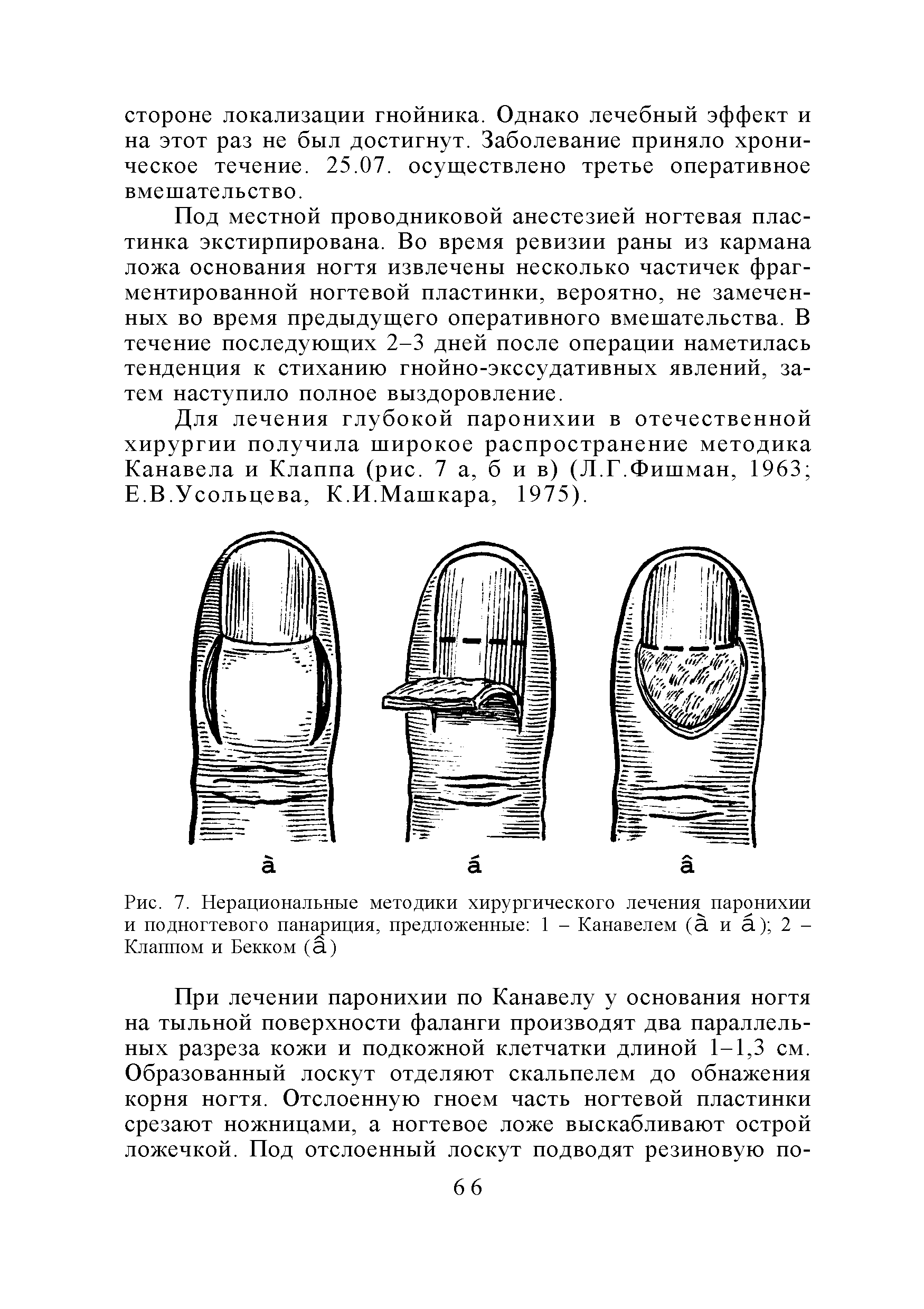 Рис. 7. Нерациональные методики хирургического лечения паронихии и подногтевого панариция, предложенные 1 - Канавелем (а. иа) 2-Клаппом и Бекком (а.)...