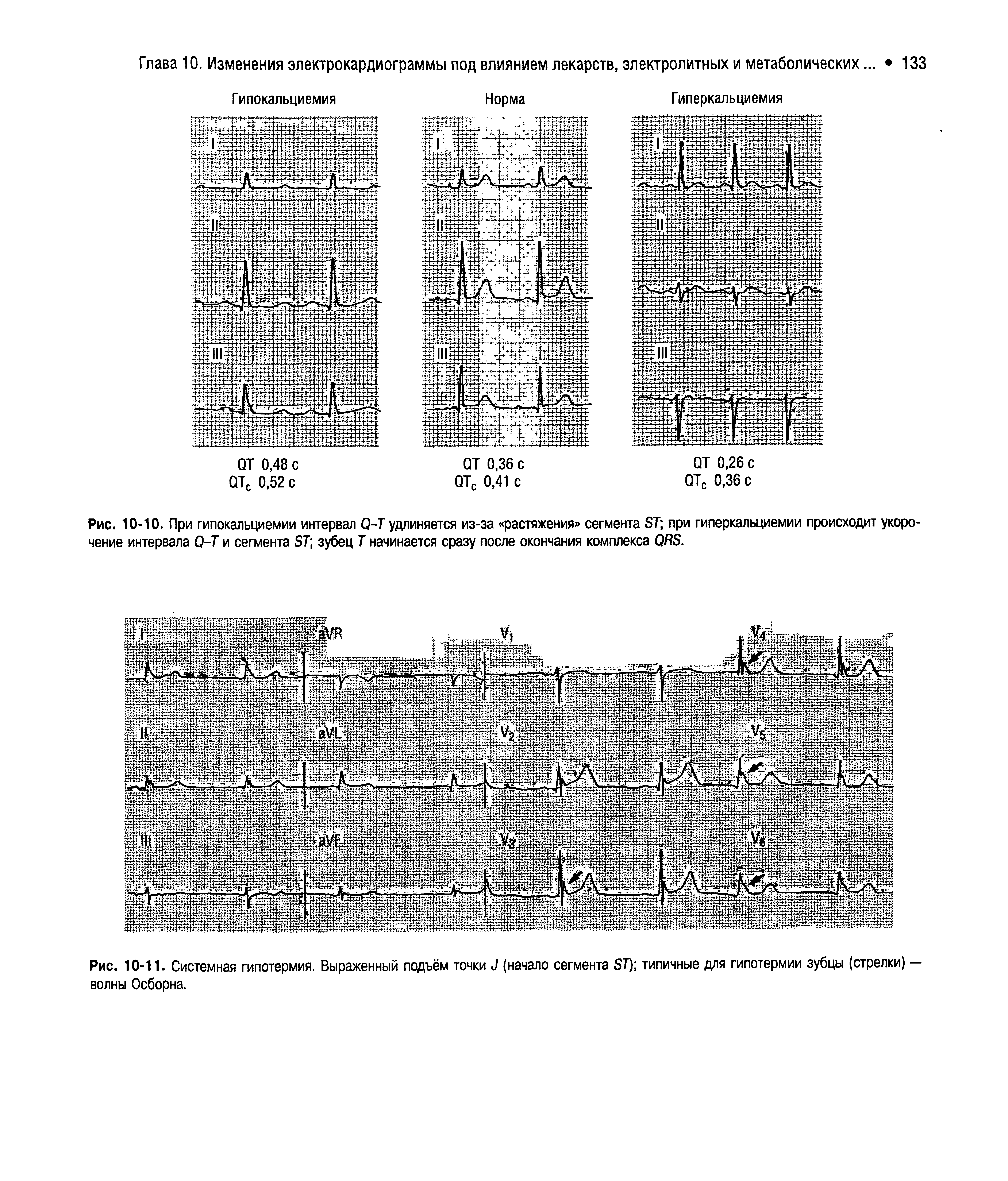 Рис. 10-10. При гипокальциемии интервал О-Т удлиняется из-за растяжения сегмента БТ при гиперкальциемии происходит укорочение интервала О-Т и сегмента БТ зубец Т начинается сразу после окончания комплекса ОЯБ.
