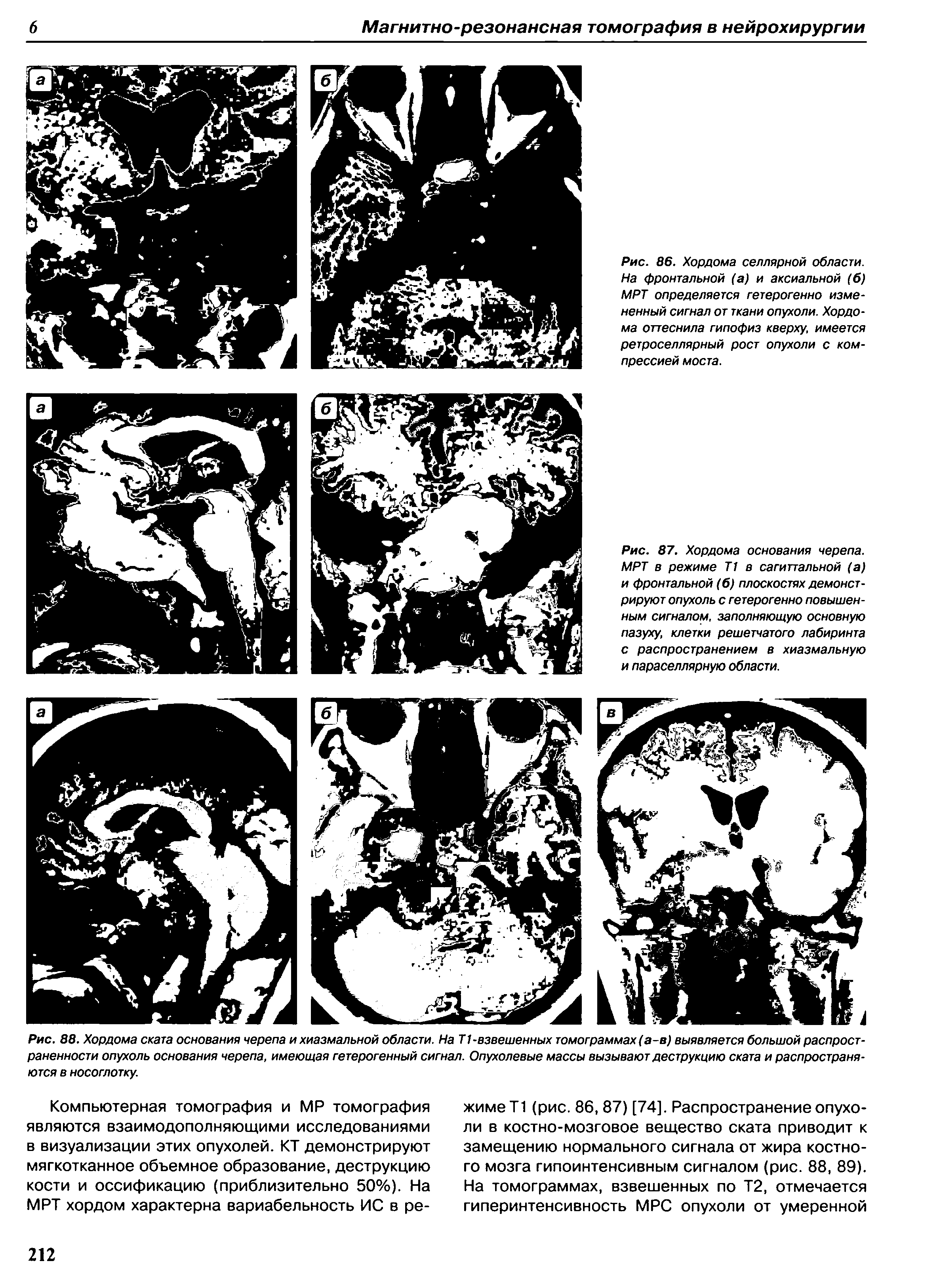 Рис. 88. Хордома ската основания черепа и хиазмальной области. На Т1-взвешенных томограммах (а-в) выявляется большой распространенности опухоль основания черепа, имеющая гетерогенный сигнал. Опухолевые массы вызывают деструкцию ската и распространяются в носоглотку.