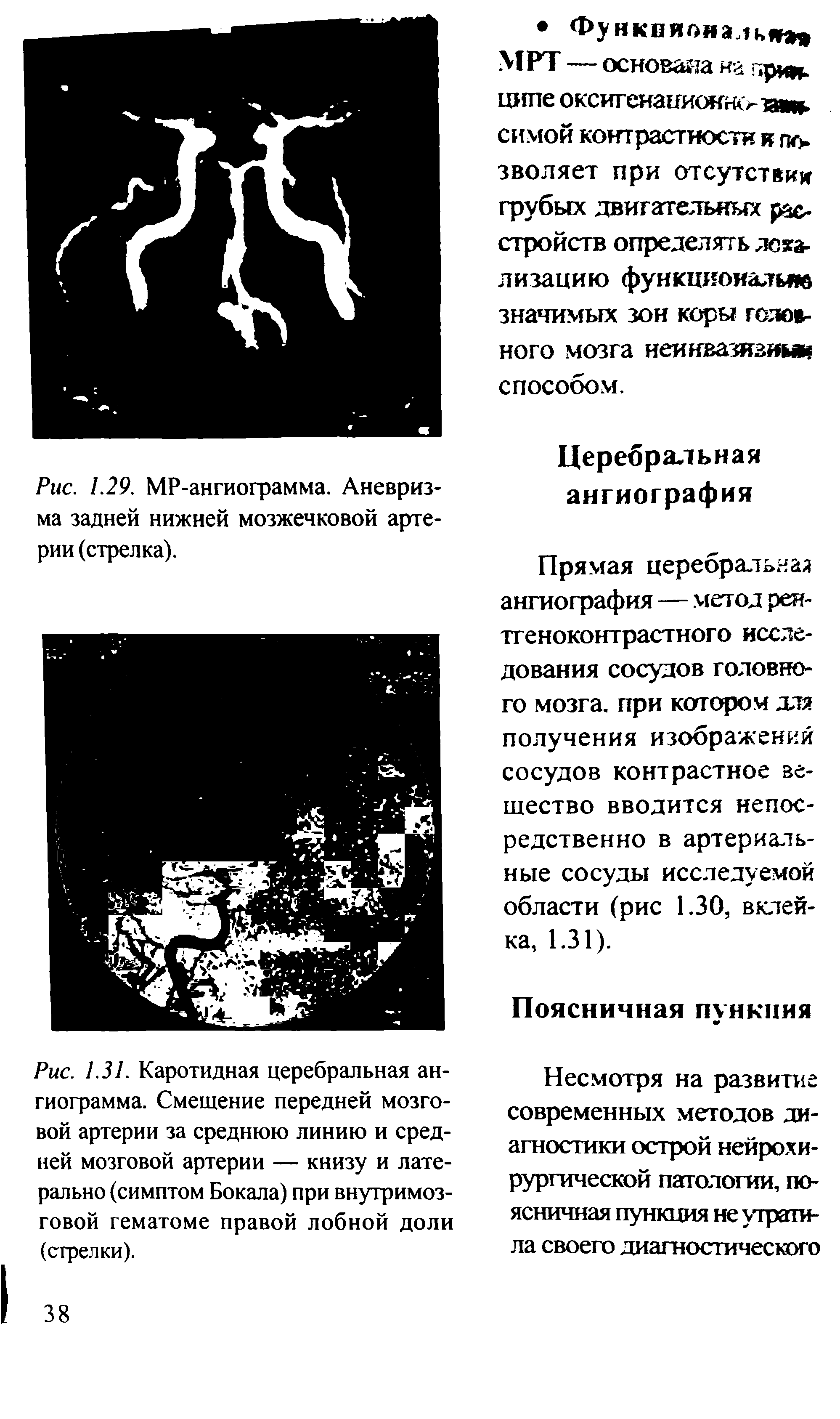 Рис. 1.31. Каротидная церебральная ангиограмма. Смещение передней мозговой артерии за среднюю линию и средней мозговой артерии — книзу и лате-рально (симптом Бокала) при внутримозговой гематоме правой лобной доли (стрелки).