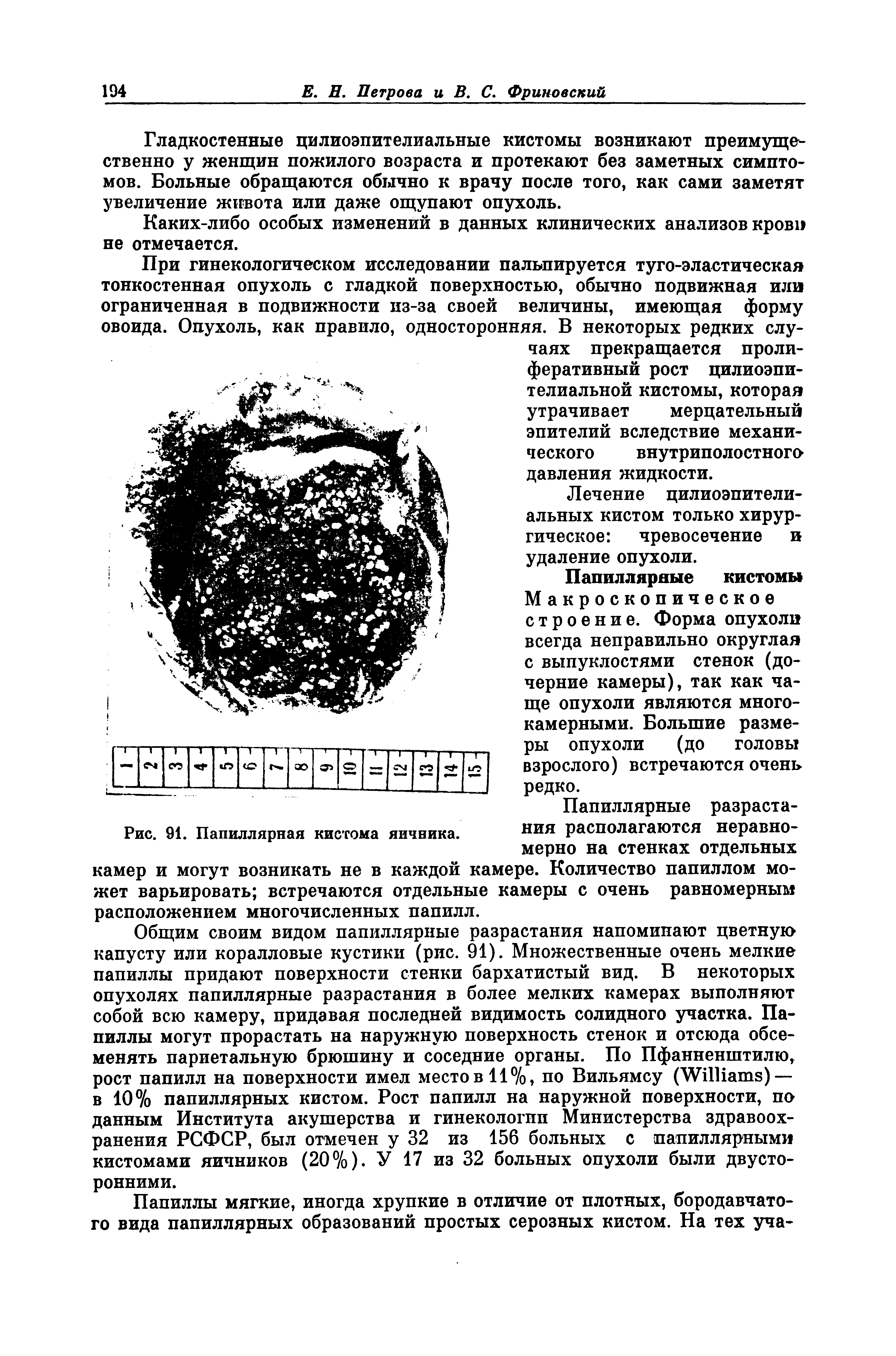 Рис. 91. Папиллярная кистома яичника, камер и могут возникать не в каждой...