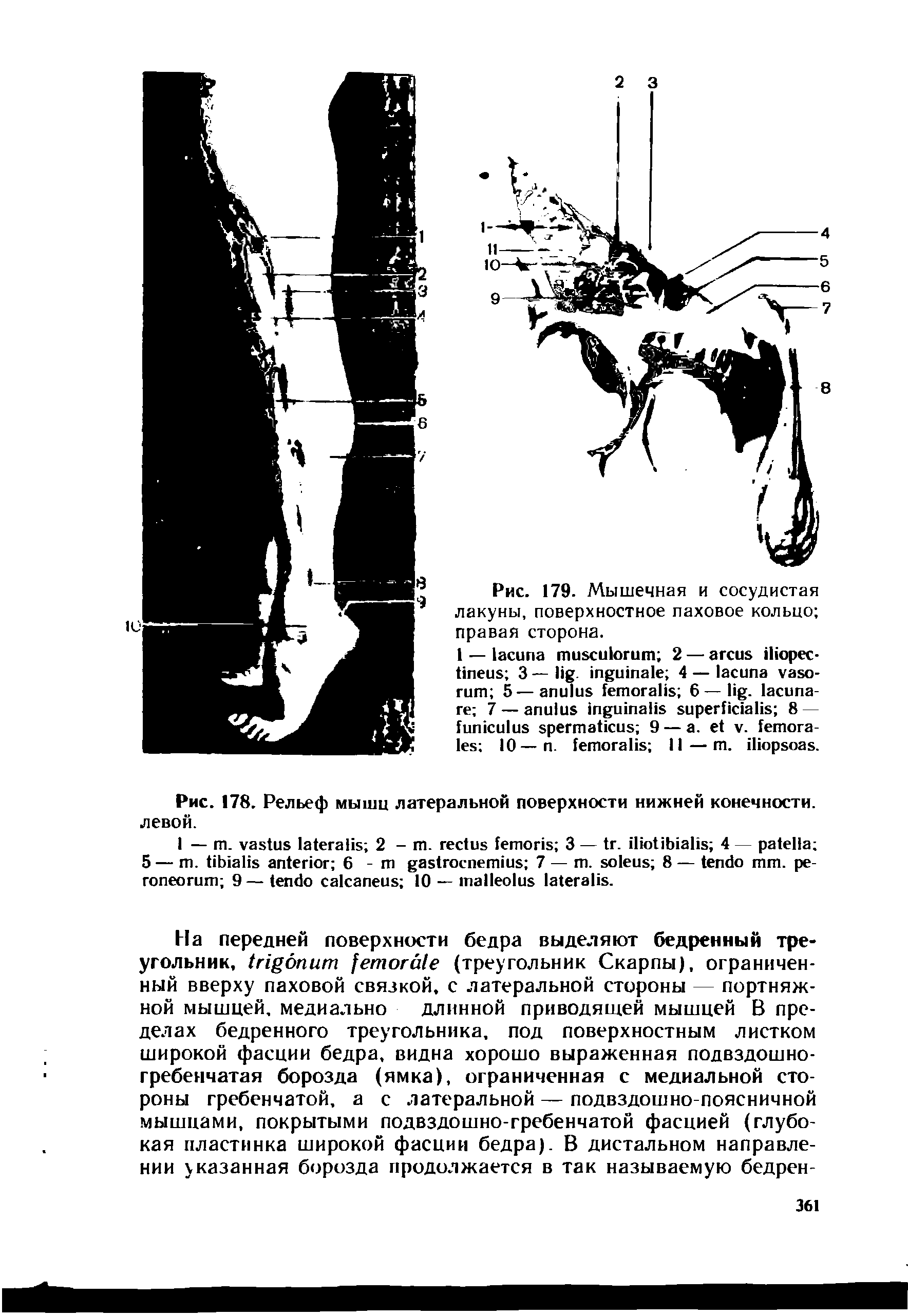 Рис. 179. Мышечная и сосудистая лакуны, поверхностное паховое кольцо правая сторона.