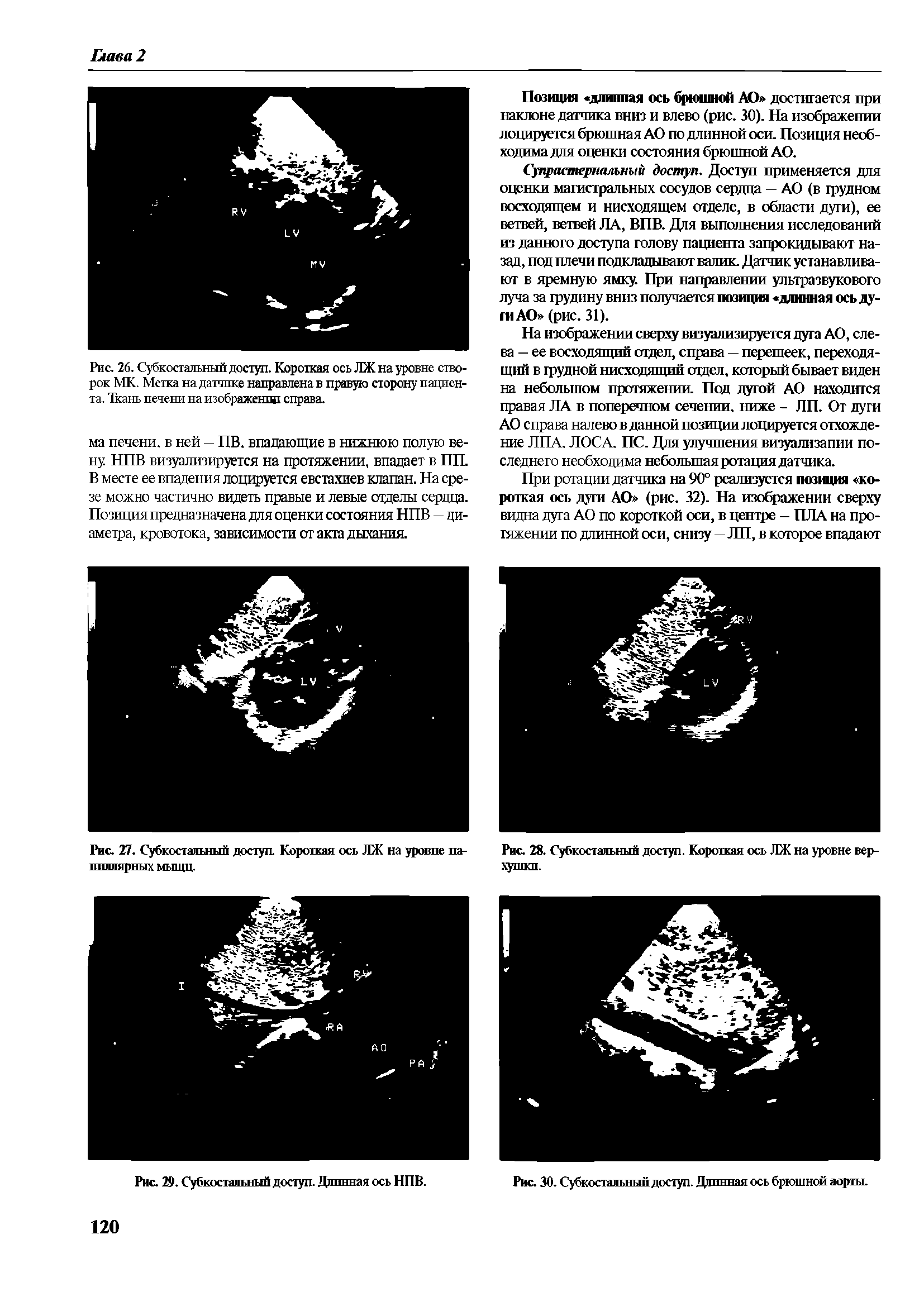 Рис. 26. Субкостальный доступ. Короткая ось ЛЖ на уровне створок МК. Метка на датчике направлена в правую сторону пациента. Ткань печени на изображенш справа.