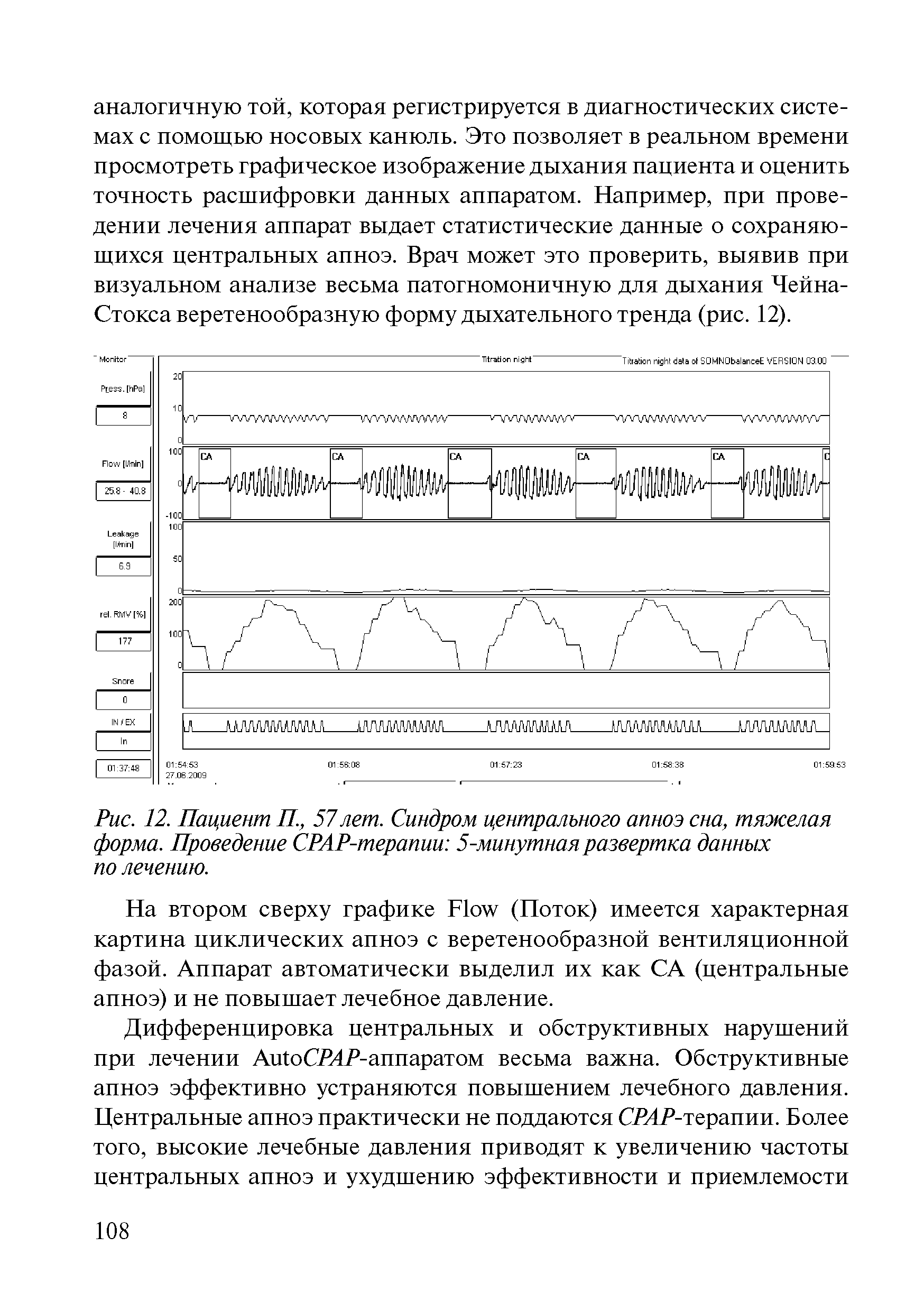 Рис. 12. Пациент П., 57лет. Синдром центрального апноэ сна, тяжелая форма. Проведение СРАР-терапии 5-минутная развертка данных по лечению.