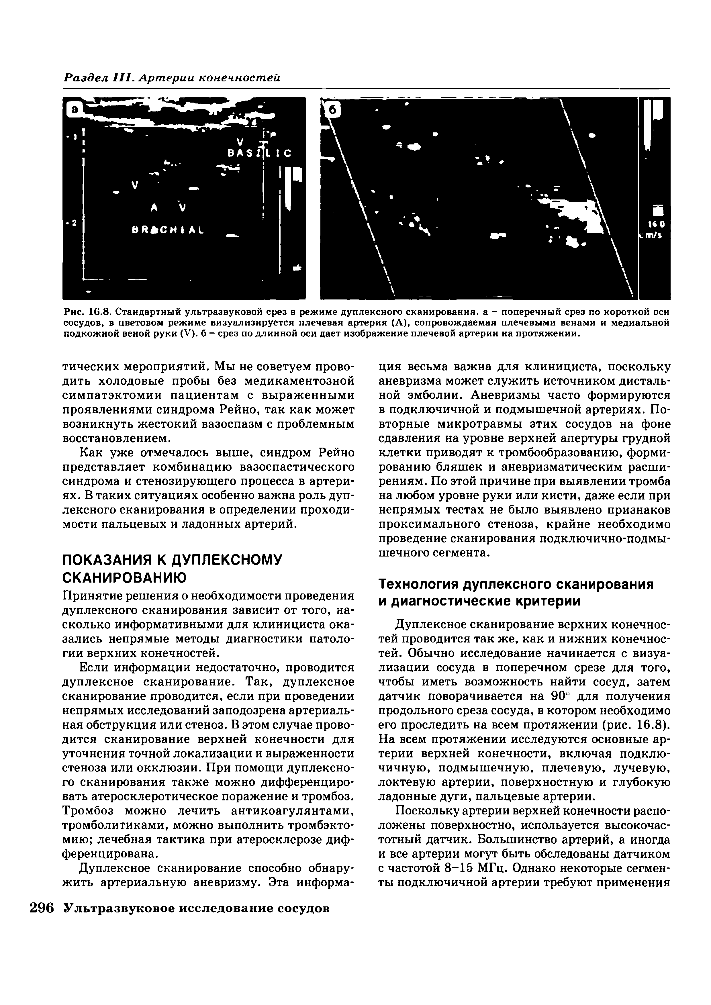 Рис. 16.8. Стандартный ультразвуковой срез в режиме дуплексного сканирования, а - поперечный срез по короткой оси сосудов, в цветовом режиме визуализируется плечевая артерия (А), сопровождаемая плечевыми венами и медиальной подкожной веной руки (V). б - срез по длинной оси дает изображение плечевой артерии на протяжении.