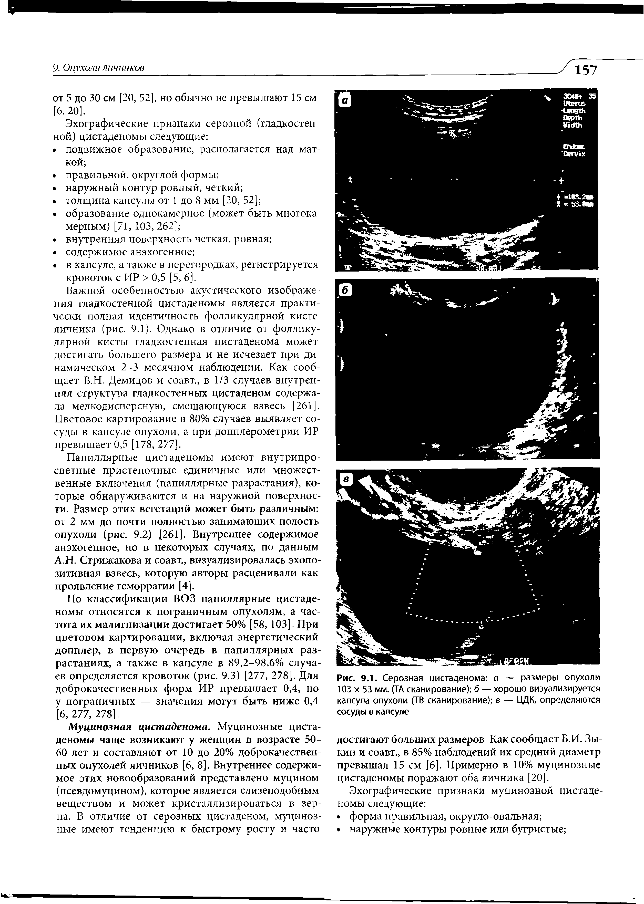 Рис. 9.1. Серозная цистаденома а — размеры опухоли 103 х 53 мм. (ТА сканирование) б — хорошо визуализируется капсула опухоли (ТВ сканирование) в — ЦДК, определяются сосуды в капсуле...