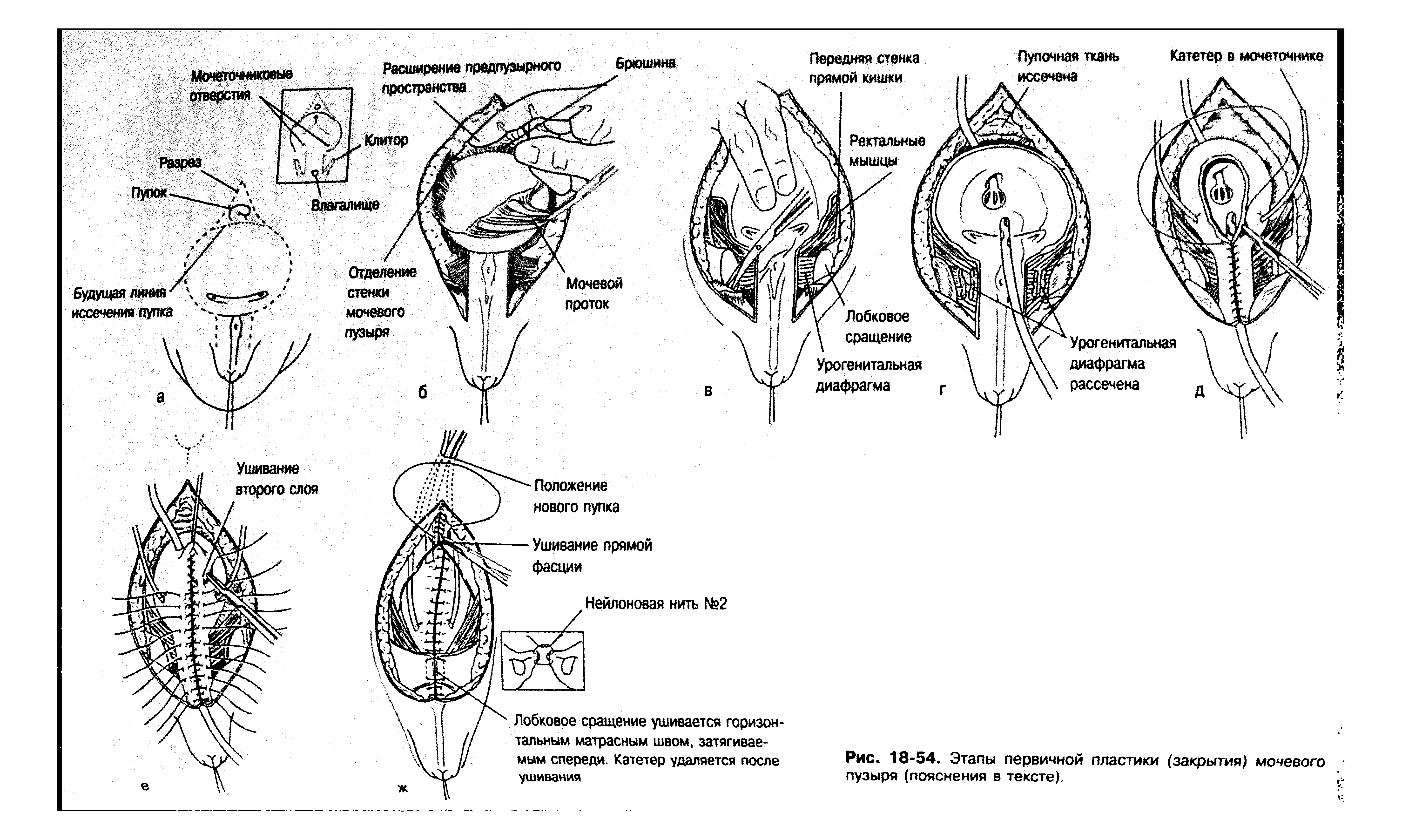 Рис. 18-54. Этапы первичной пластики (закрытия) мочевого пузыря (пояснения в тексте).