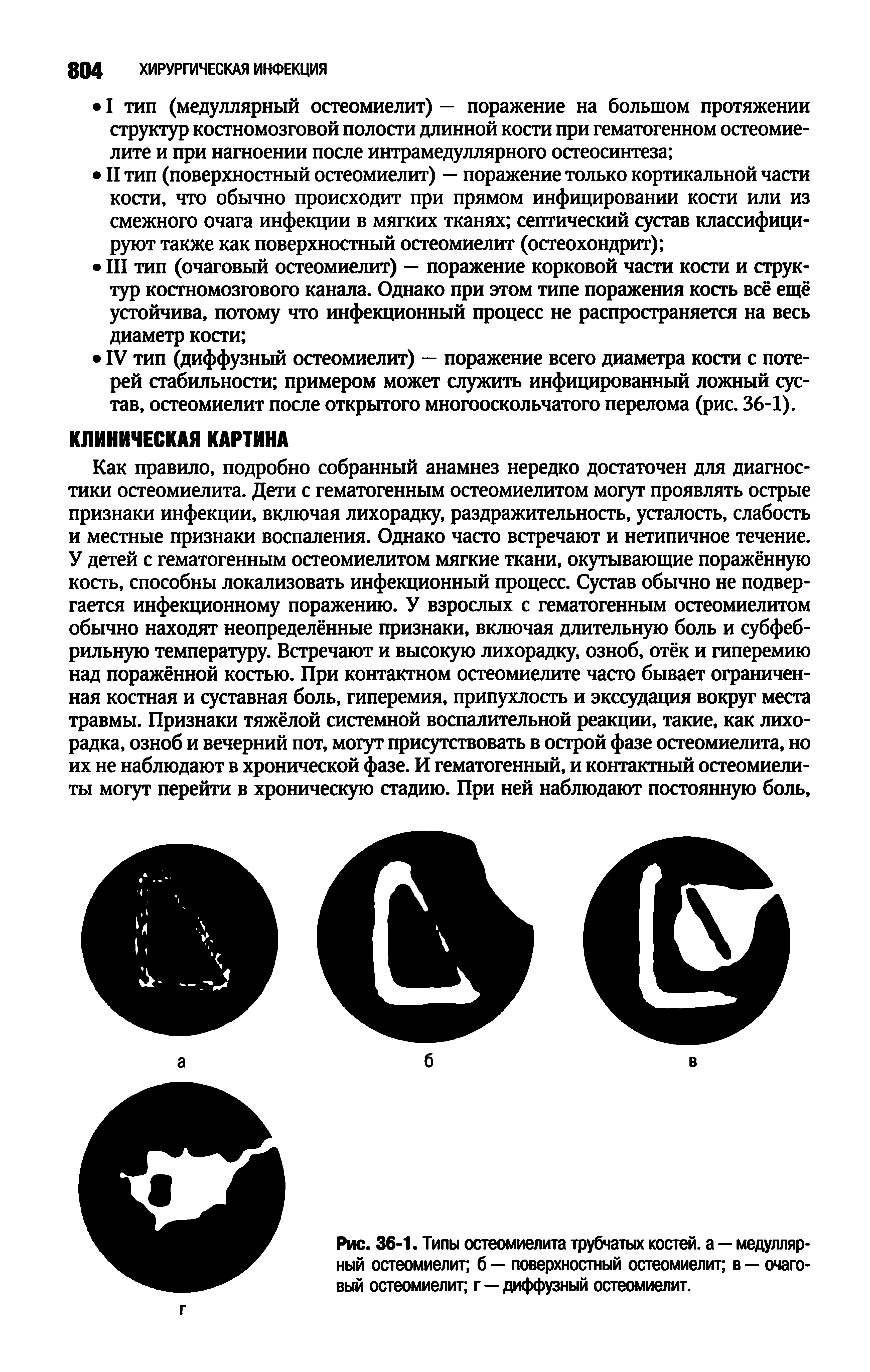 Рис. 36-1. Типы остеомиелита трубчатых костей, а — медуллярный остеомиелит б — поверхностный остеомиелит в — очаговый остеомиелит г —диффузный остеомиелит.