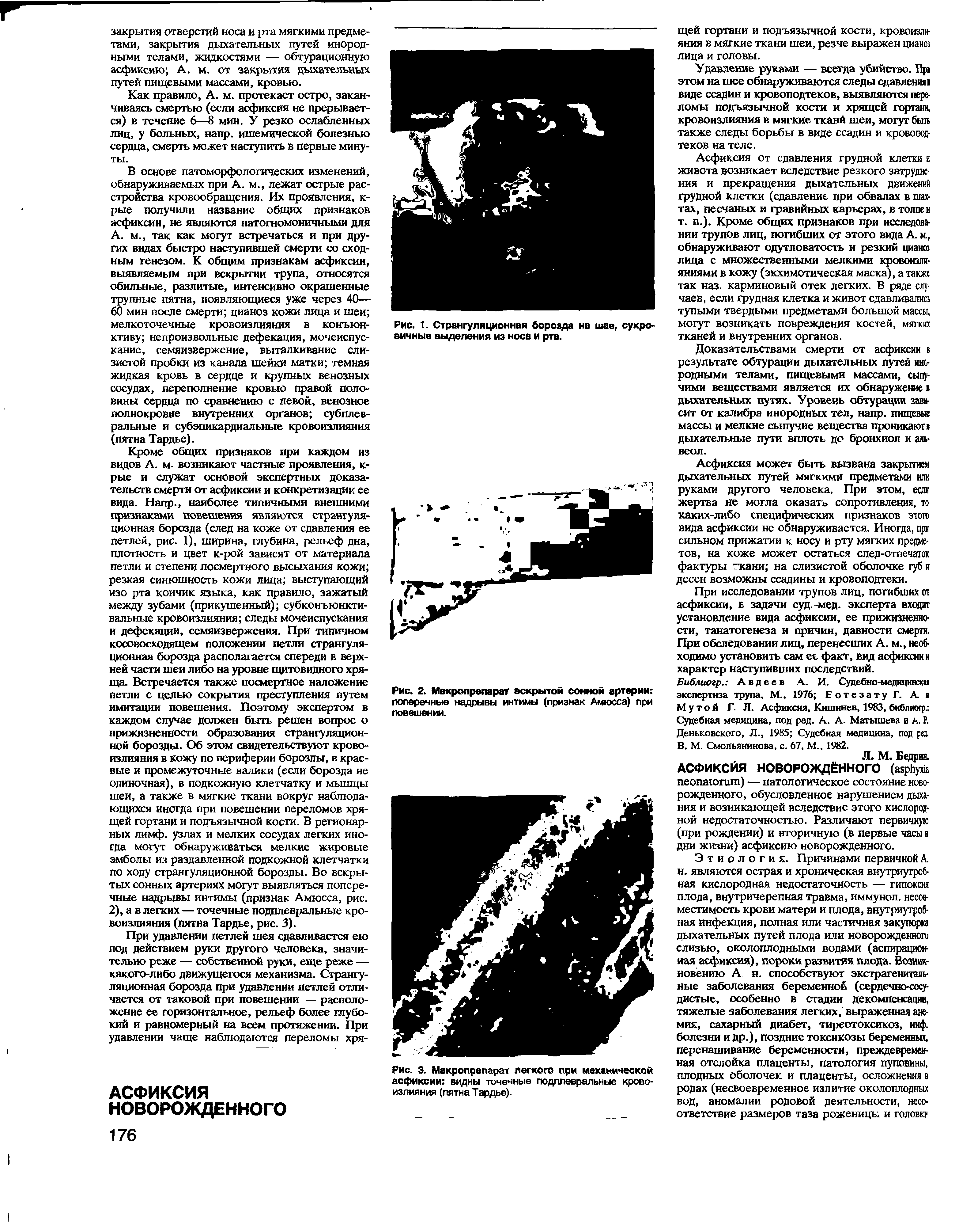 Рис. 2. Макропрепарат вскрытой сонной артерии поперечные надрывы интимы (признак Амюсса) при повешении.