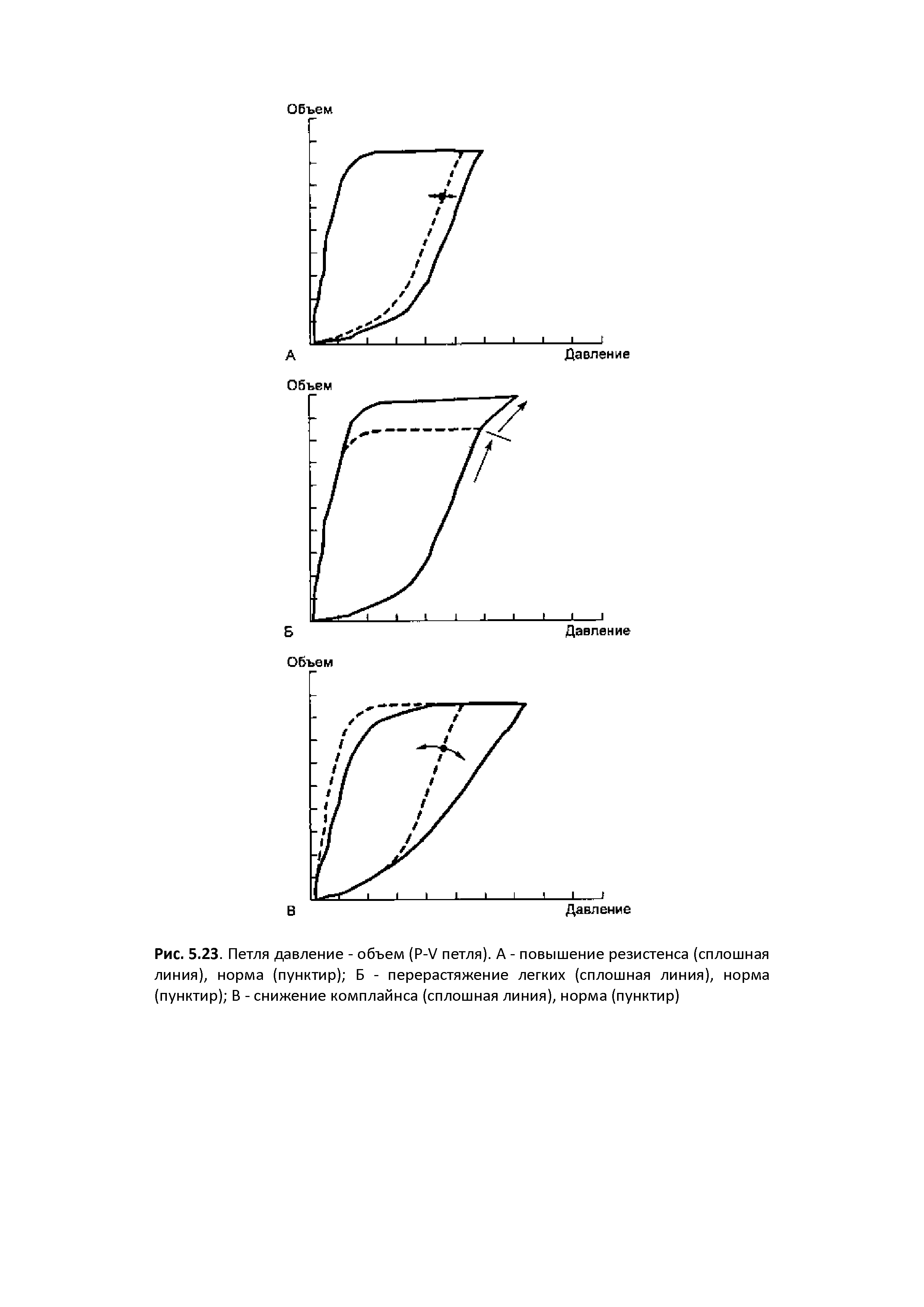 Рис. 5.23. Петля давление - объем (Р- / петля). А - повышение резистенса (сплошная линия), норма (пунктир) Б - перерастяжение легких (сплошная линия), норма (пунктир) В - снижение комплайнса (сплошная линия), норма (пунктир)...