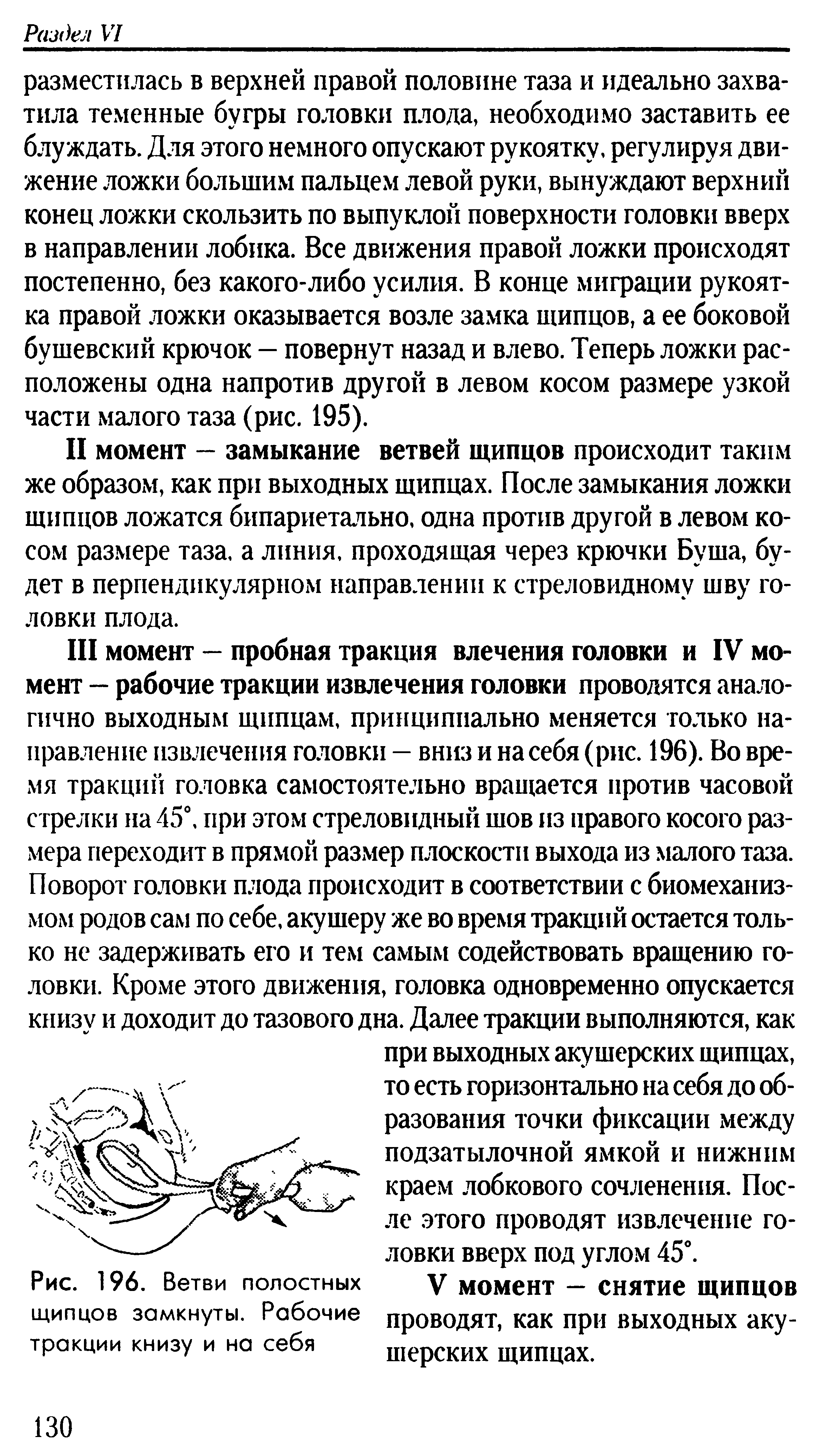 Рис. 196. Ветви полостных щипцов замкнуты. Рабочие тракции книзу и на себя...