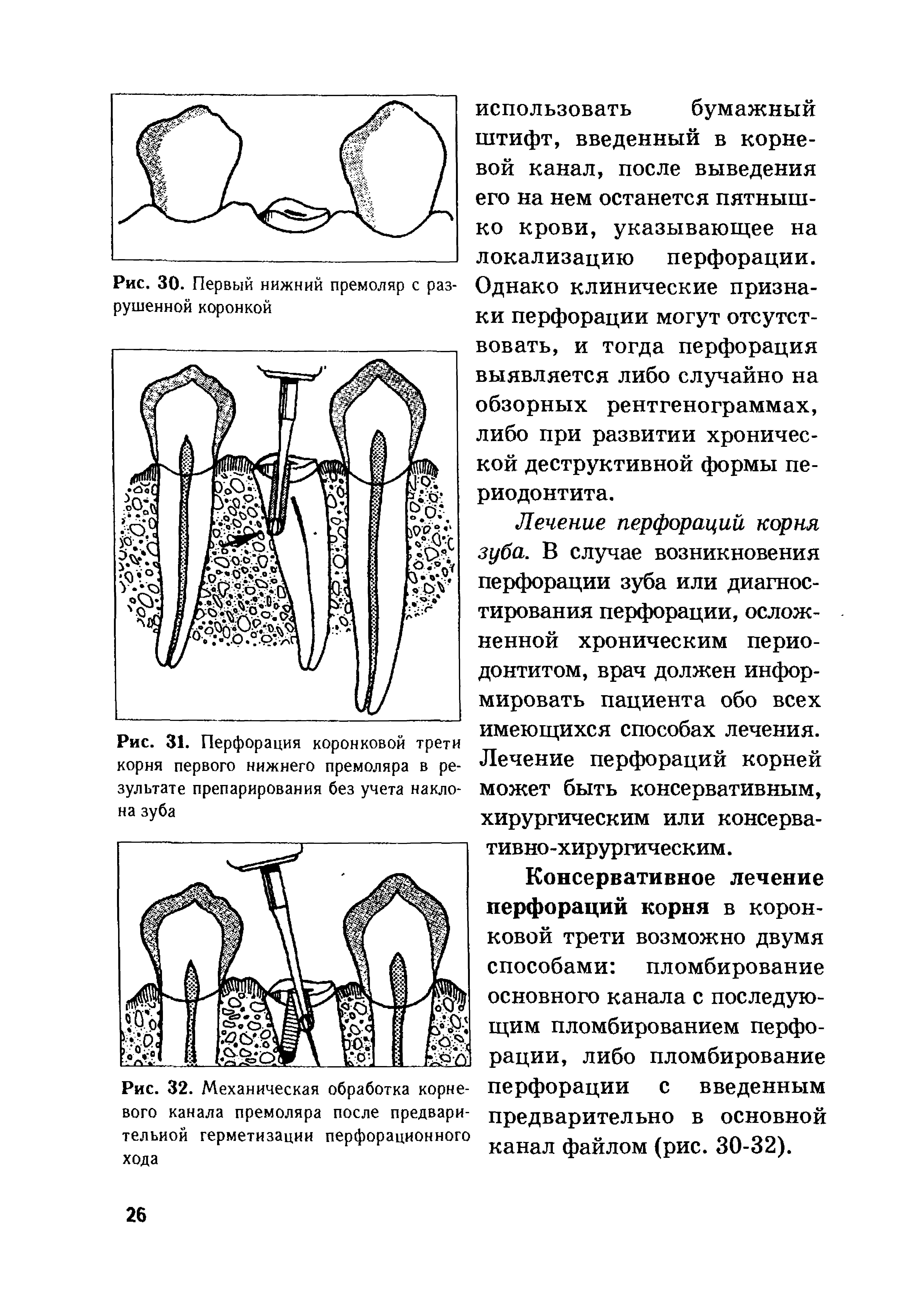 Рис. 31. Перфорация коронковой трети корня первого нижнего премоляра в результате препарирования без учета наклона зуба...