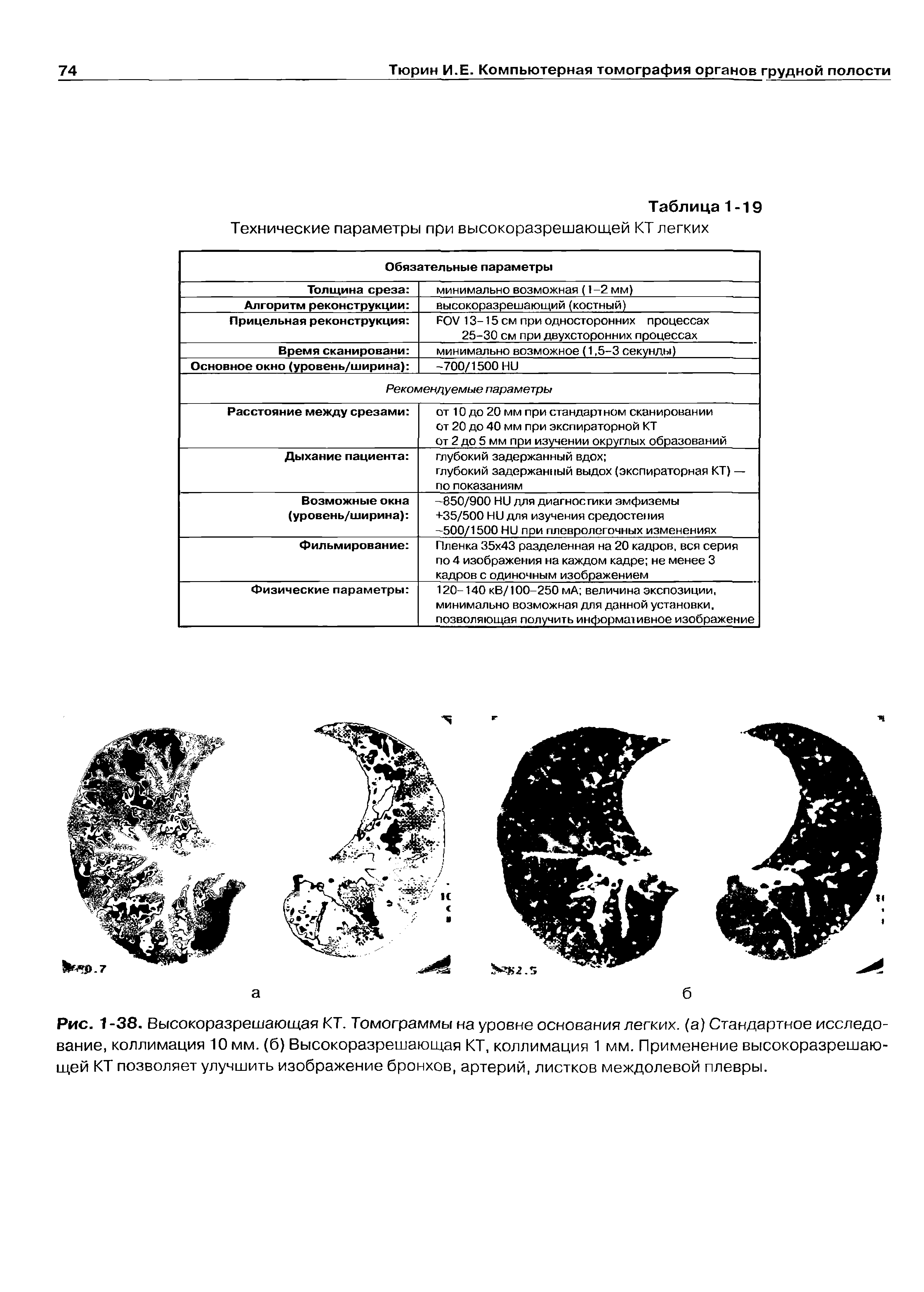 Рис. 1-38. Высокоразрешающая КТ. Томограммы на уровне основания легких, (а) Стандартное исследование, коллимация 10 мм. (б) Высокоразрешающая КТ, коллимация 1 мм. Применение высокоразрешающей КТ позволяет улучшить изображение бронхов, артерий, листков междолевой плевры.