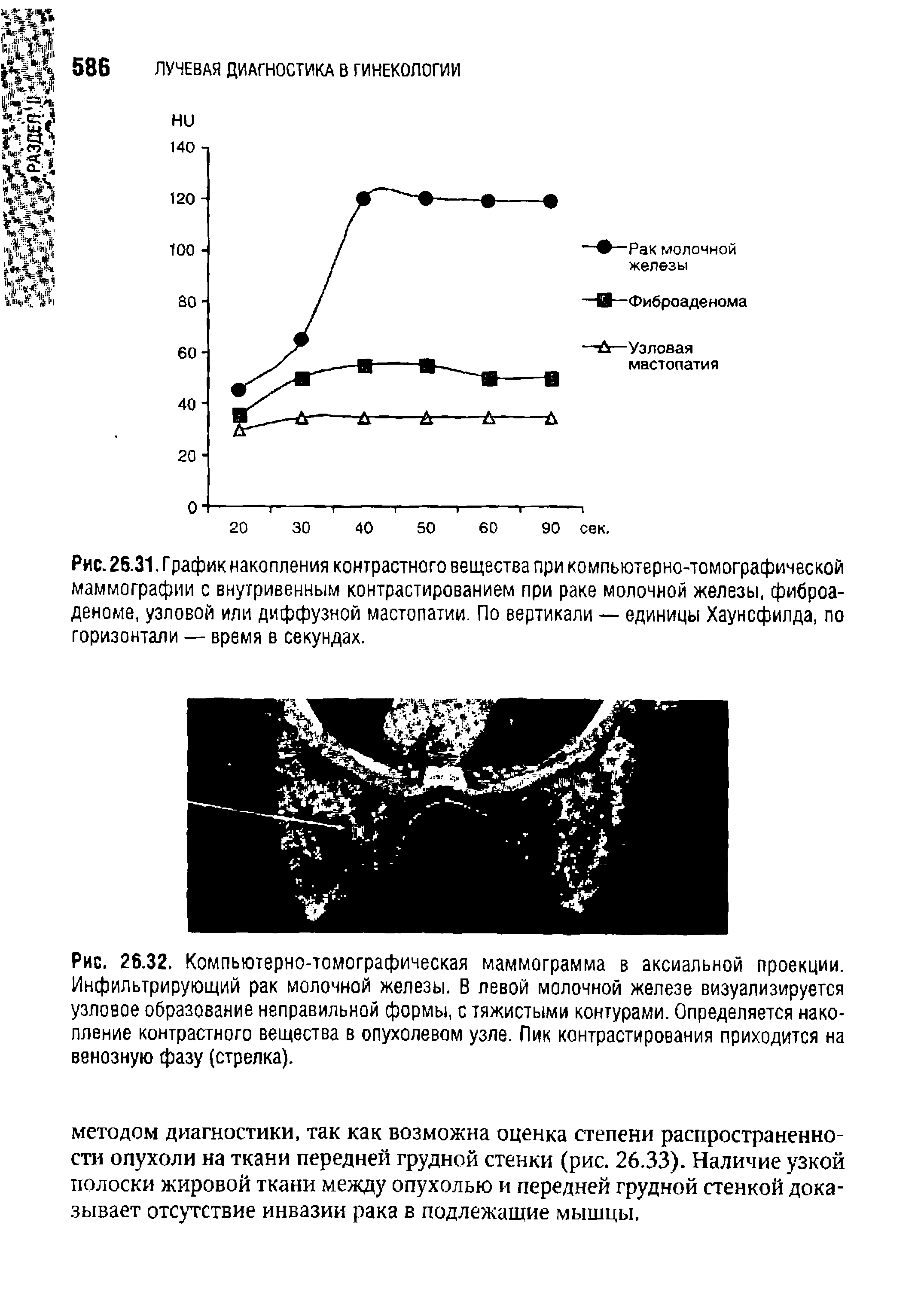 Рис. 26.31. Г рафик накопления контрастного вещества при компьютерно-томографической маммографии с внутривенным контрастированием при раке молочной железы, фиброаденоме, узловой или диффузной мастопатии. По вертикали — единицы Хаунсфилда, по горизонтали — время в секундах.