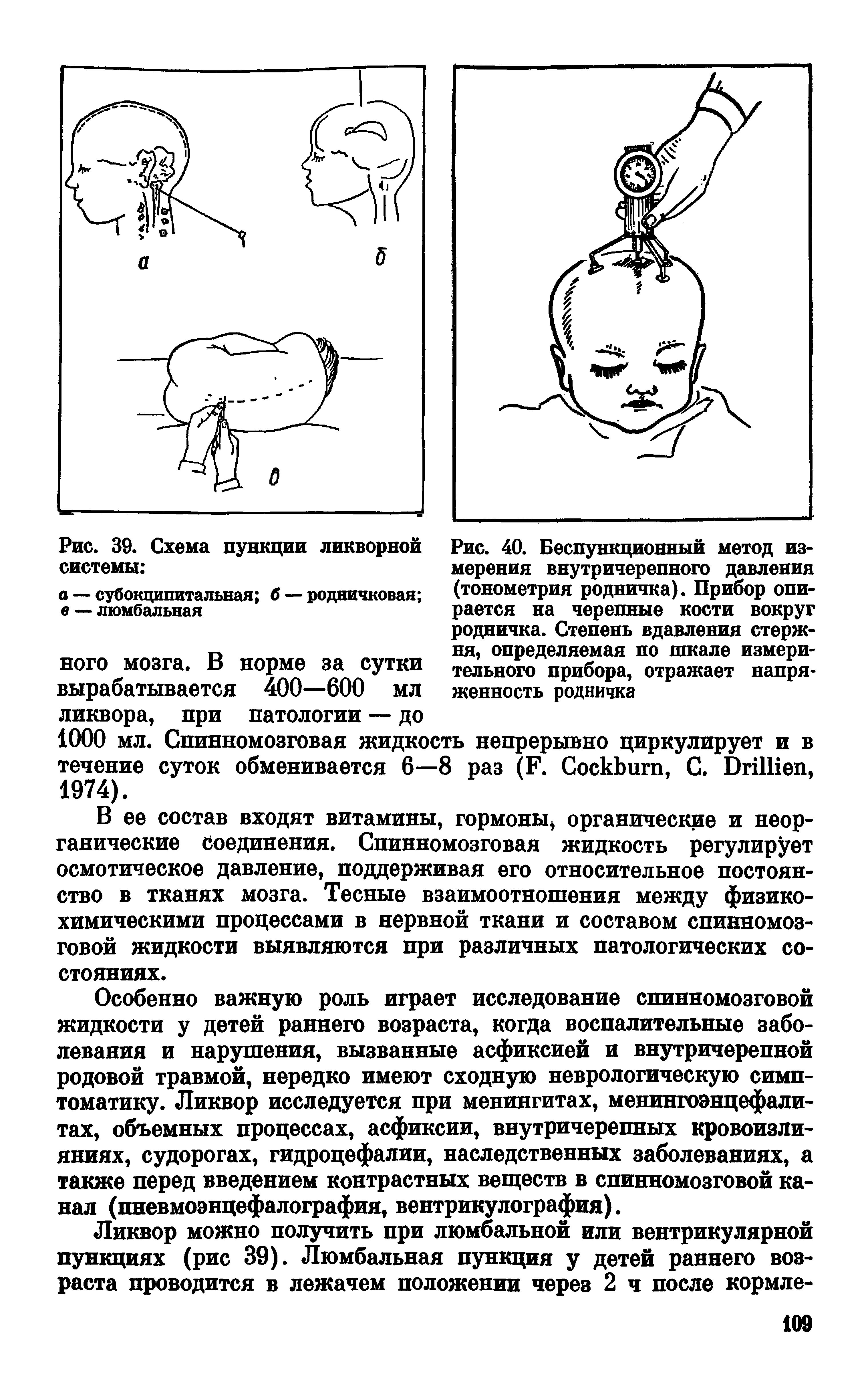 Рис. 40. Беспункционный метод измерения внутричерепного давления (тонометрия родничка). Прибор опирается на черепные кости вокруг родничка. Степень вдавления стержня, определяемая по шкале измерительного прибора, отражает напряженность родничка...