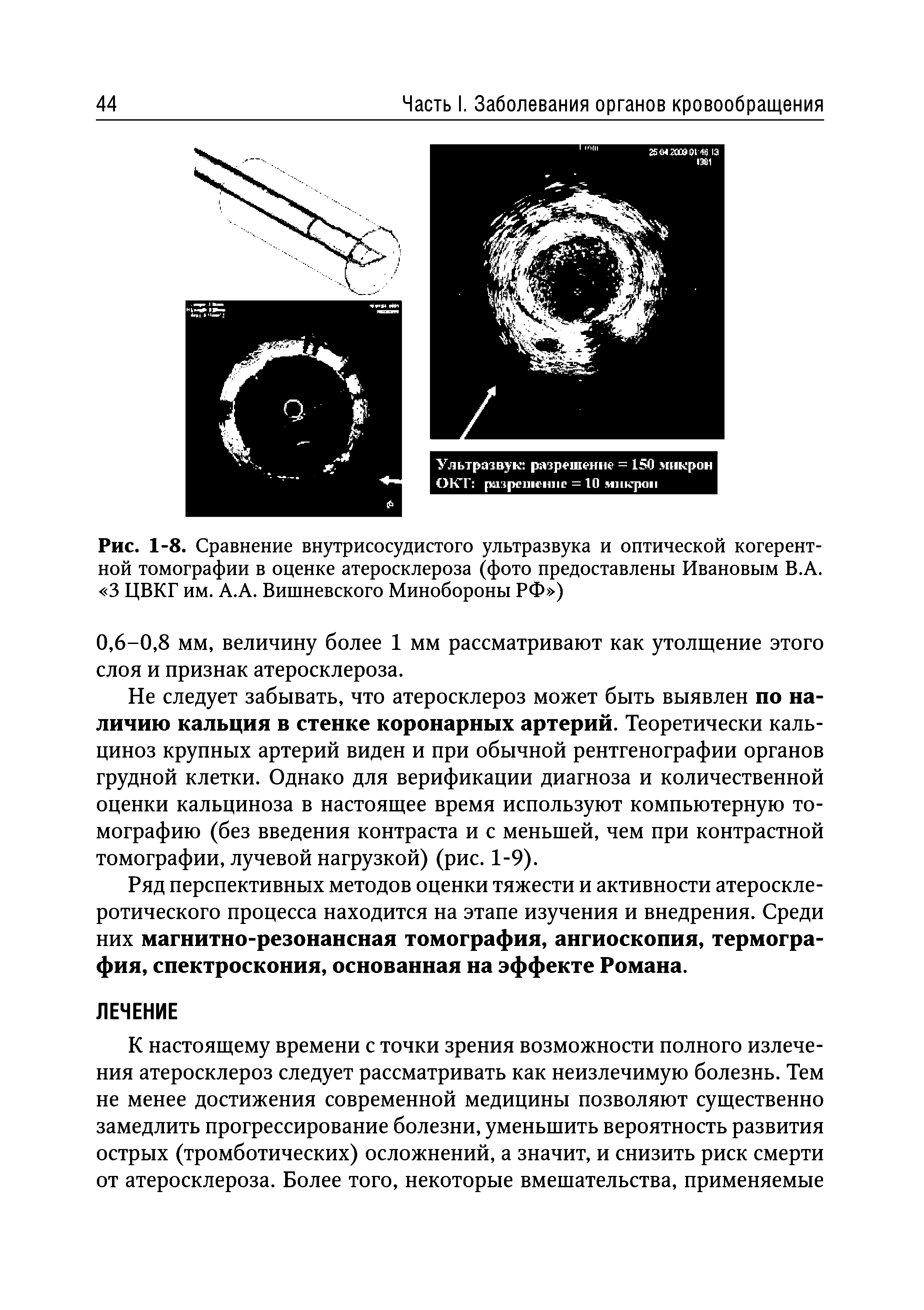Рис. 1-8. Сравнение внутрисосудистого ультразвука и оптической когерентной томографии в оценке атеросклероза (фото предоставлены Ивановым В.А. 3 ЦВКГ им. А.А. Вишневского Минобороны РФ )...