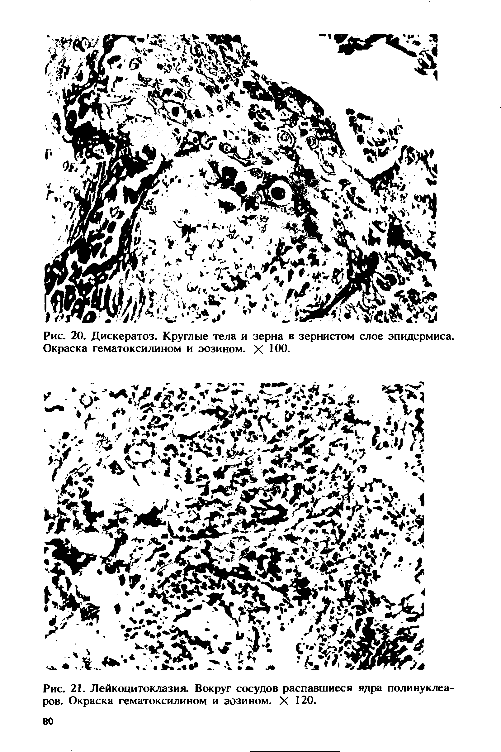 Рис. 21. Лейкоцитоклазия. Вокруг сосудов распавшиеся ядра полинуклеа-ров. Окраска гематоксилином и эозином. X 120.