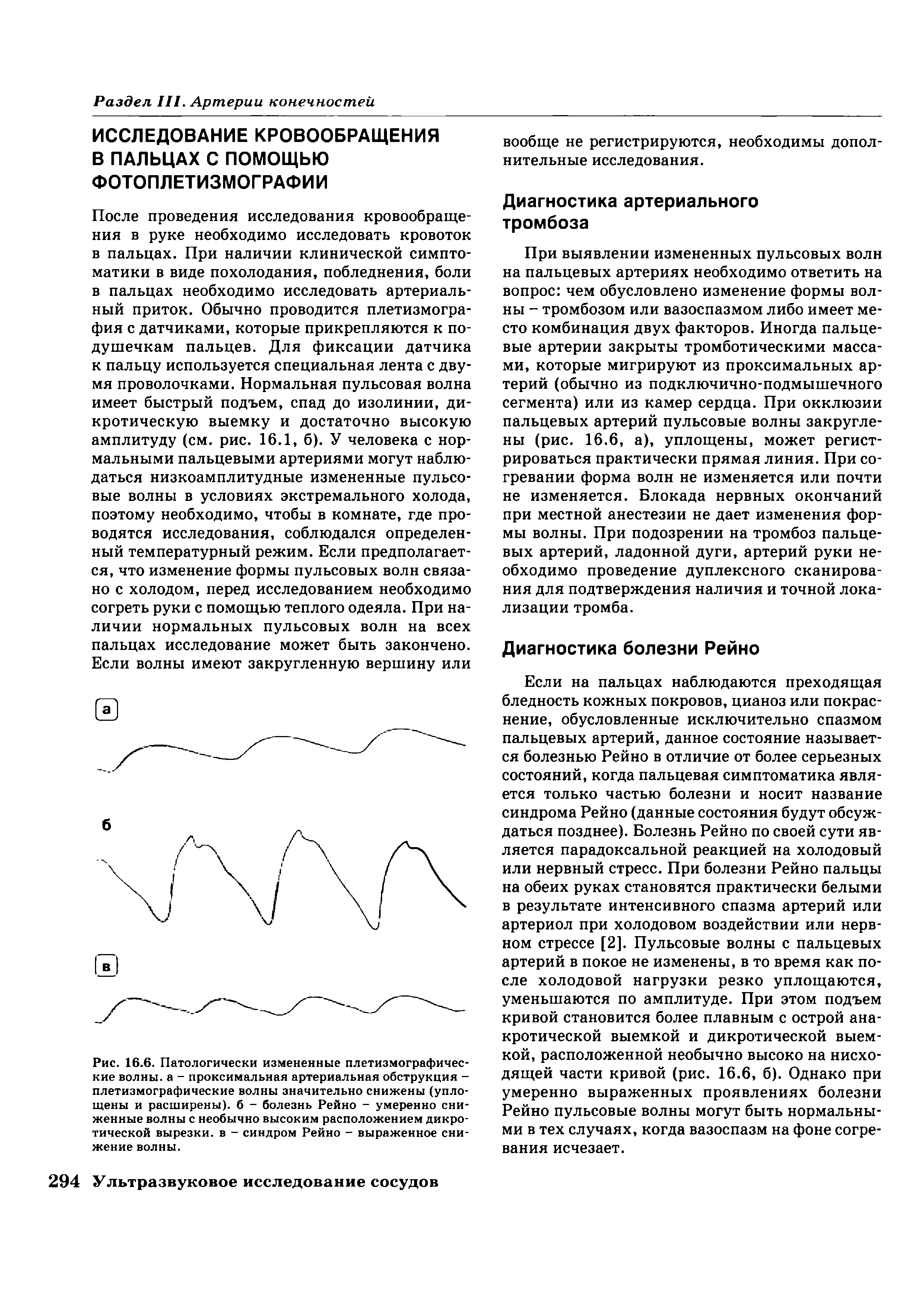 Рис. 16.6. Патологически измененные плетизмографические волны, а - проксимальная артериальная обструкция -плетизмографические волны значительно снижены (уплощены и расширены), б - болезнь Рейно - умеренно сниженные волны с необычно высоким расположением дикротической вырезки, в - синдром Рейно - выраженное снижение волны.