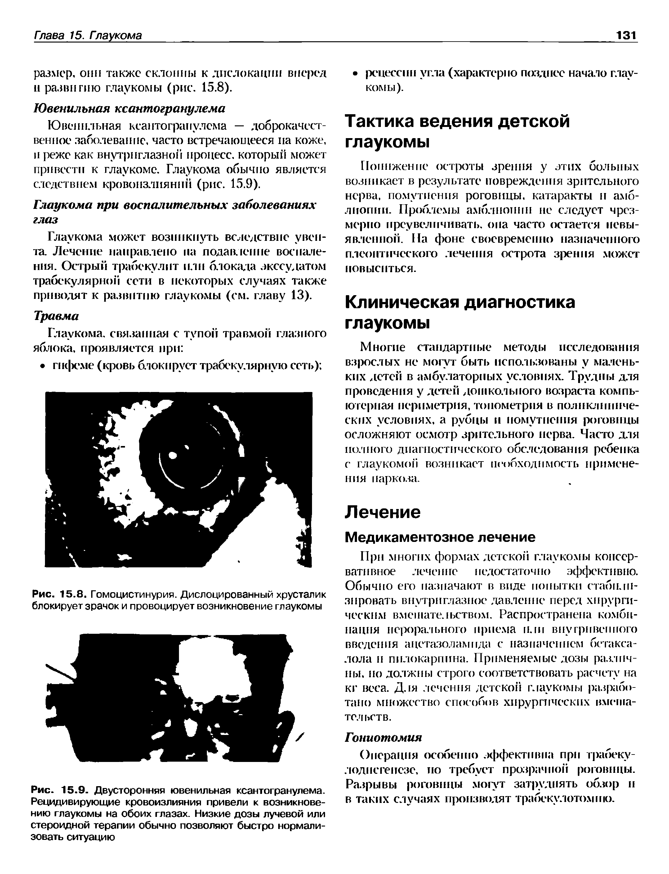 Рис. 15.9. Двусторонняя ювенильная ксантогранулема. Рецидивирующие кровоизлияния привели к возникновению глаукомы на обоих глазах. Низкие дозы лучевой или стероидной терапии обычно позволяют быстро нормализовать ситуацию...