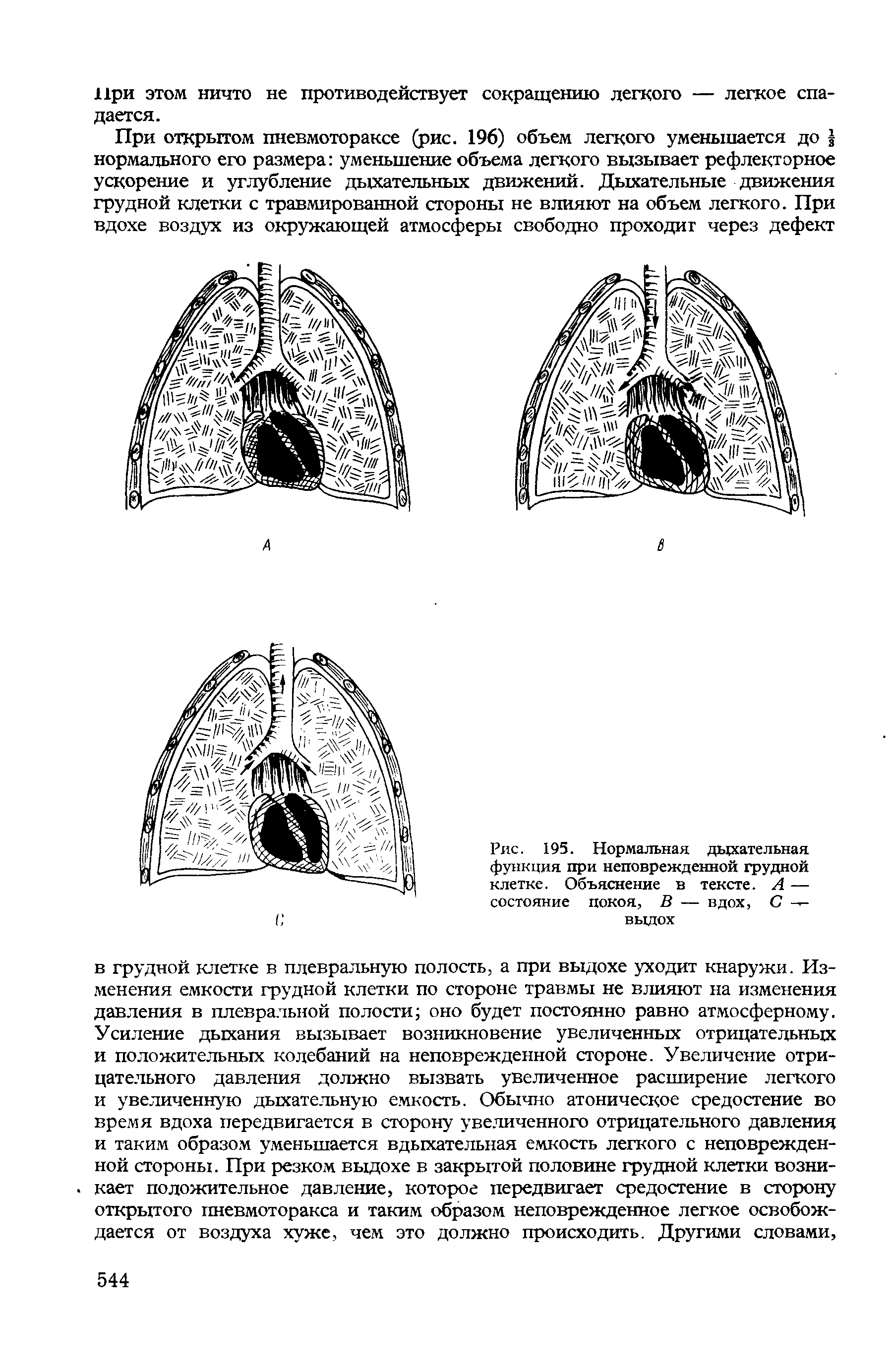 Рис. 195. Нормальная дыхательная функция при неповрежденной грудной клетке. Объяснение в тексте. А — состояние покоя, В — вдох, С выдох...
