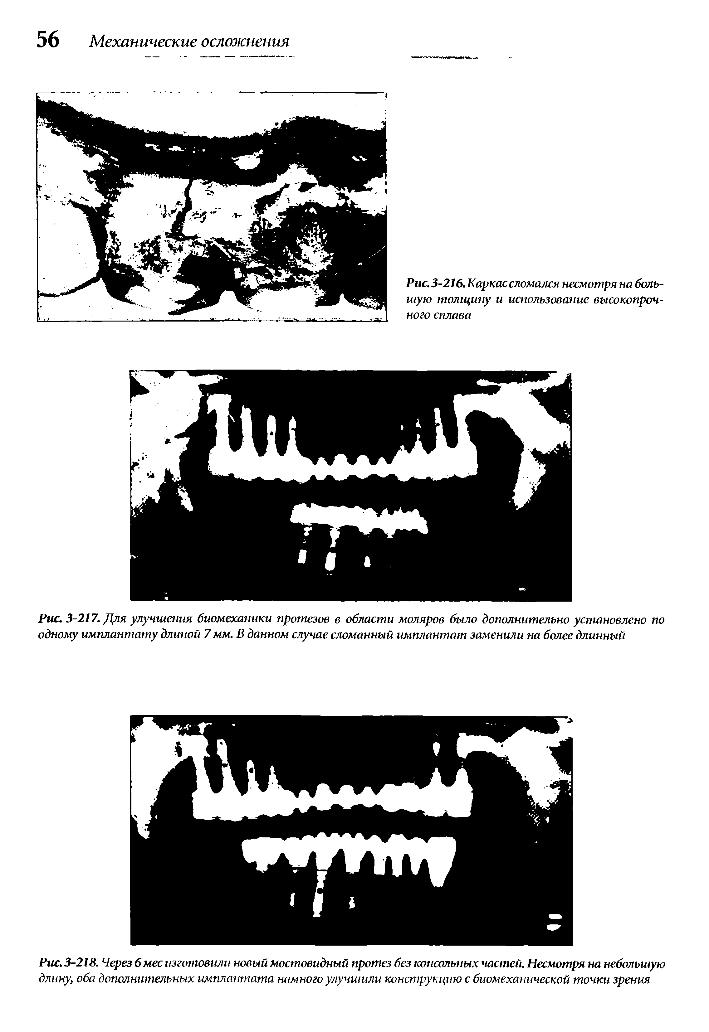 Рис. 3-217. Для улучшения биомеханики протезов в области моляров было дополнительно установлено по одному имплантату длиной 7 мм. В данном случае сломанный имплантат заменили на более длинный...