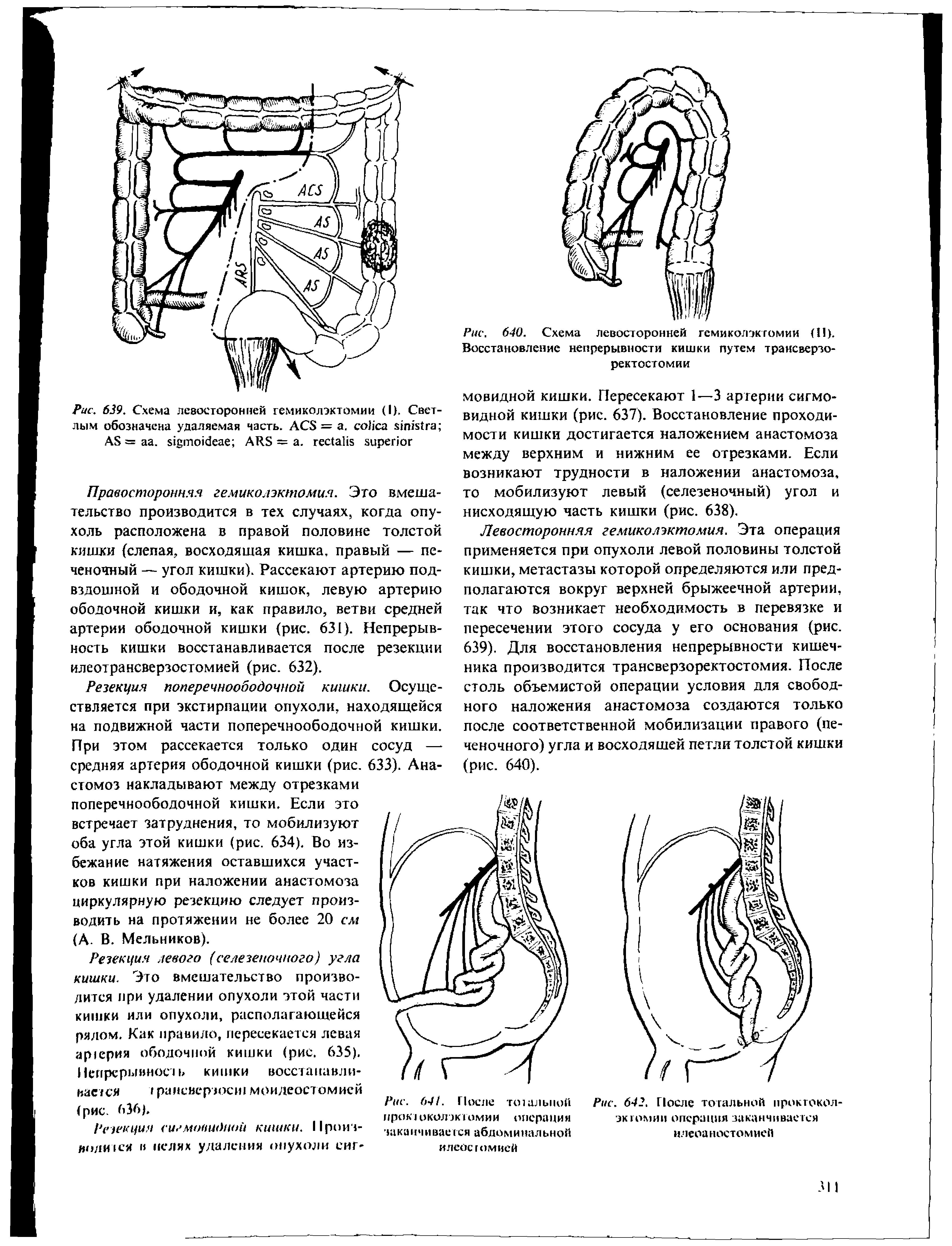 Рис. 640. Схема левосторонней гемиколэкгомии (II). Восстановление непрерывности кишки путем трансверзо-ректостомии...