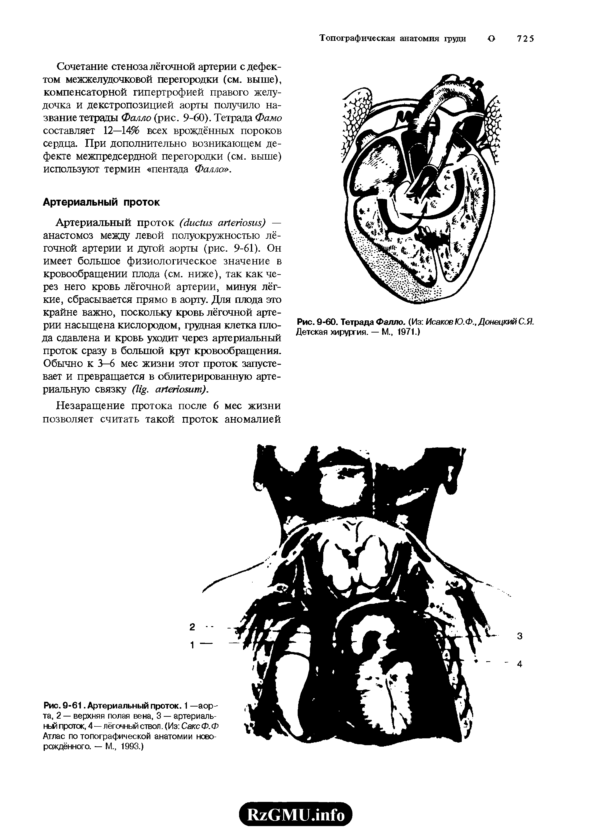 Рис. 9-61. Артериальный проток. 1 —аорта, 2 — верхняя полая вена, 3 — артериаль-ньй проток, 4 — лёгочный ствол. (Из СаксФ.Ф Атлас по топографической анатомии новорождённого. — М., 1993.)...