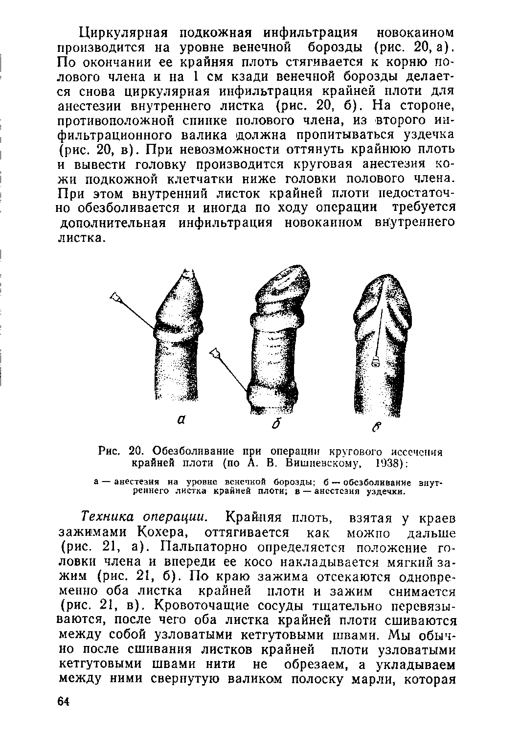 Рис. 20. Обезболивание при операции кругового иссечения крайней плоти (по А. В. Вишневскому, 1938) ...