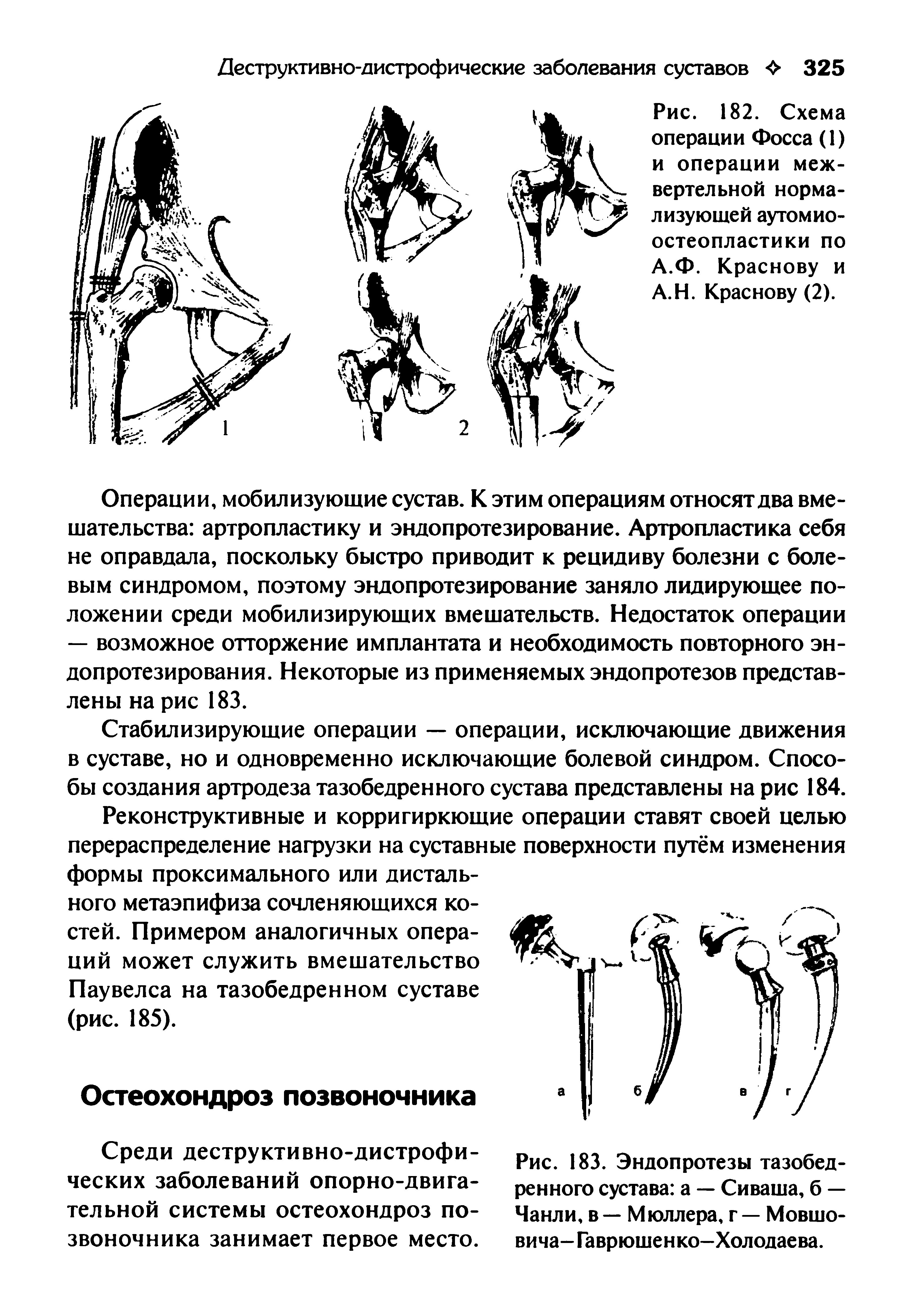 Рис. 182. Схема операции Фосса (1) и операции межвертельной нормализующей аутомиоостеопластики по А.Ф. Краснову и А.Н. Краснову (2).