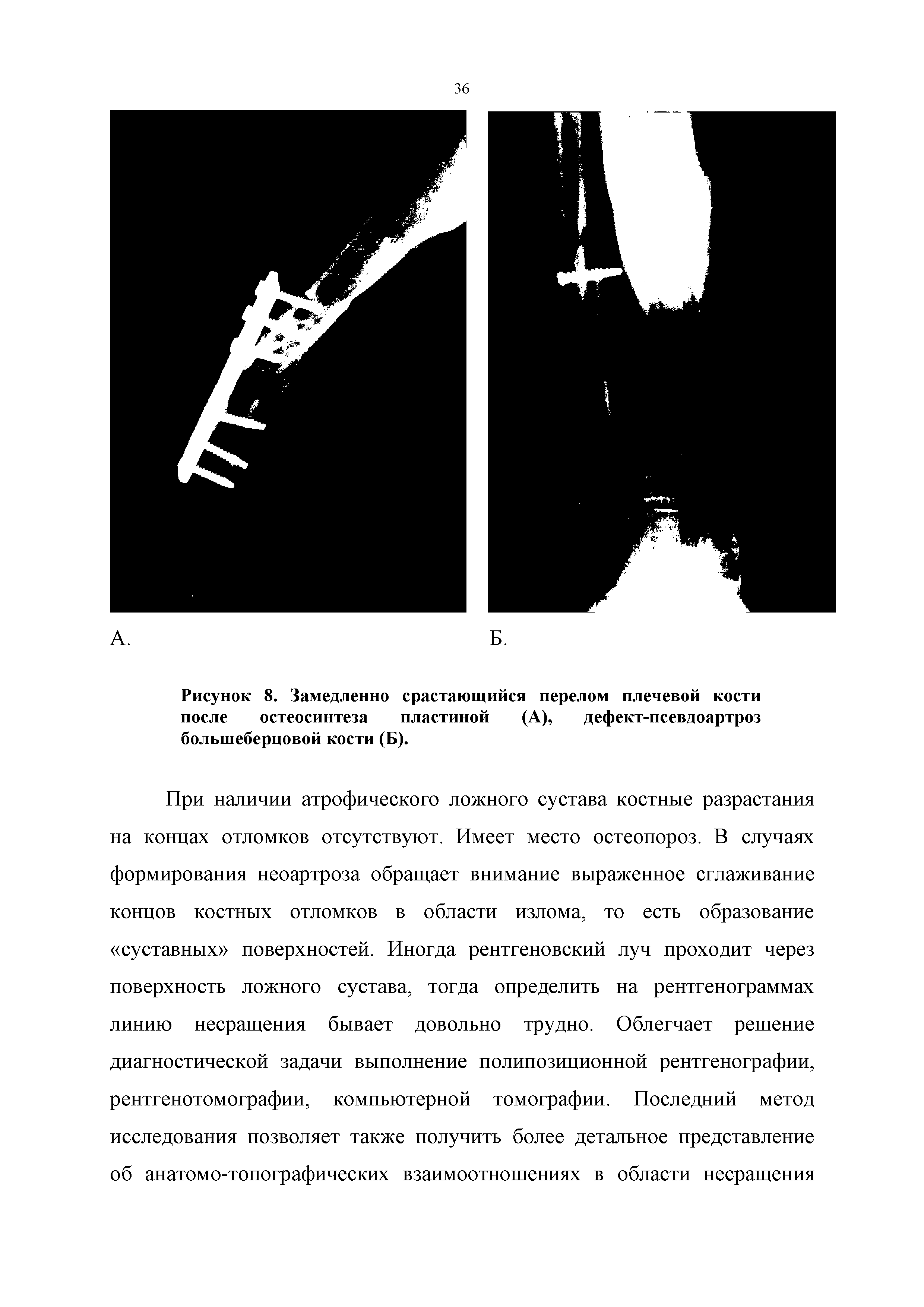 Рисунок 8. Замедленно срастающийся перелом плечевой кости после остеосинтеза пластиной (А), дефект-псевдоартроз большеберцовой кости (Б).