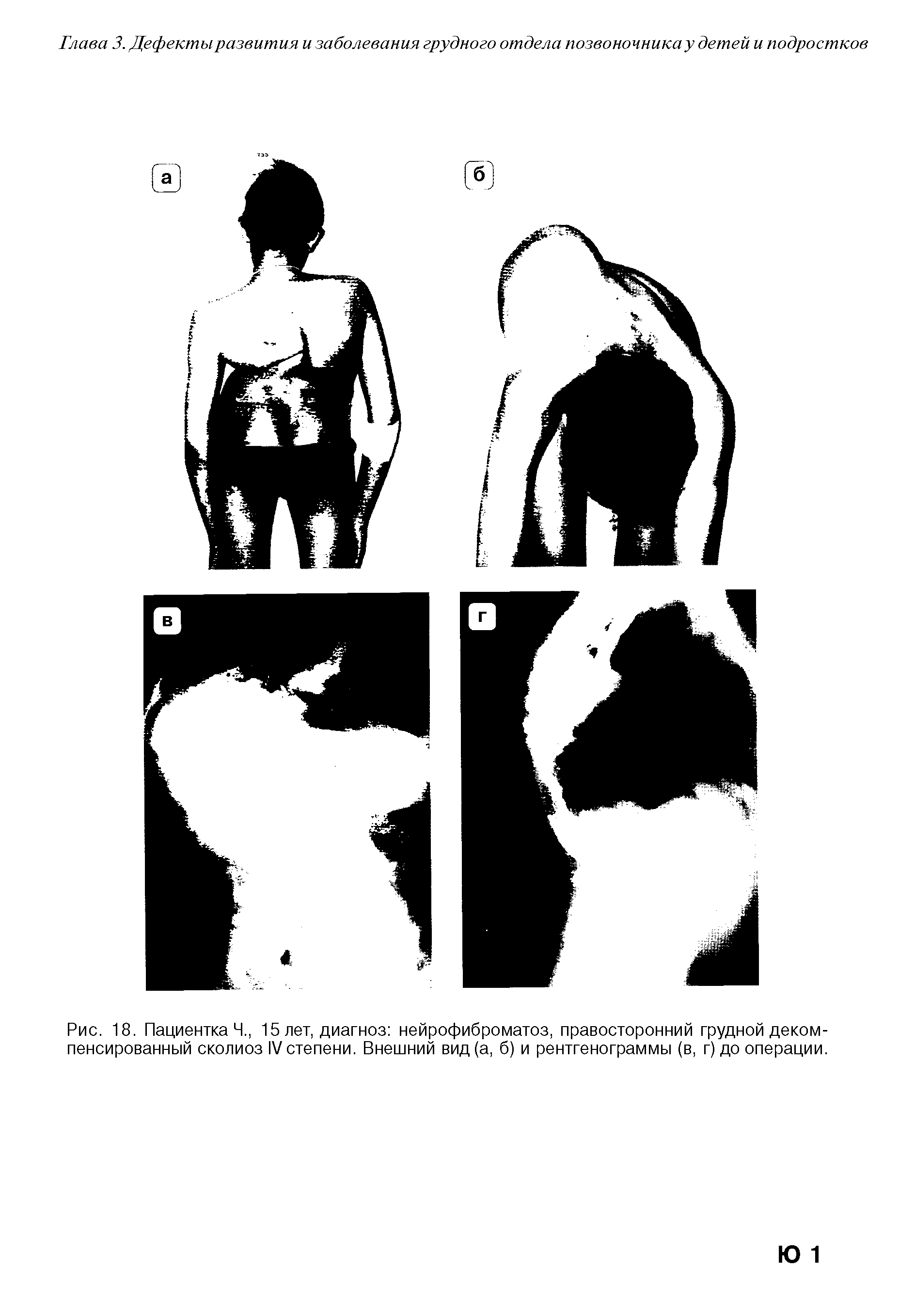 Рис. 18. Пациентка Ч., 15 лет, диагноз нейрофиброматоз, правосторонний грудной декомпенсированный сколиоз IV степени. Внешний вид (а, б) и рентгенограммы (в, г) до операции.