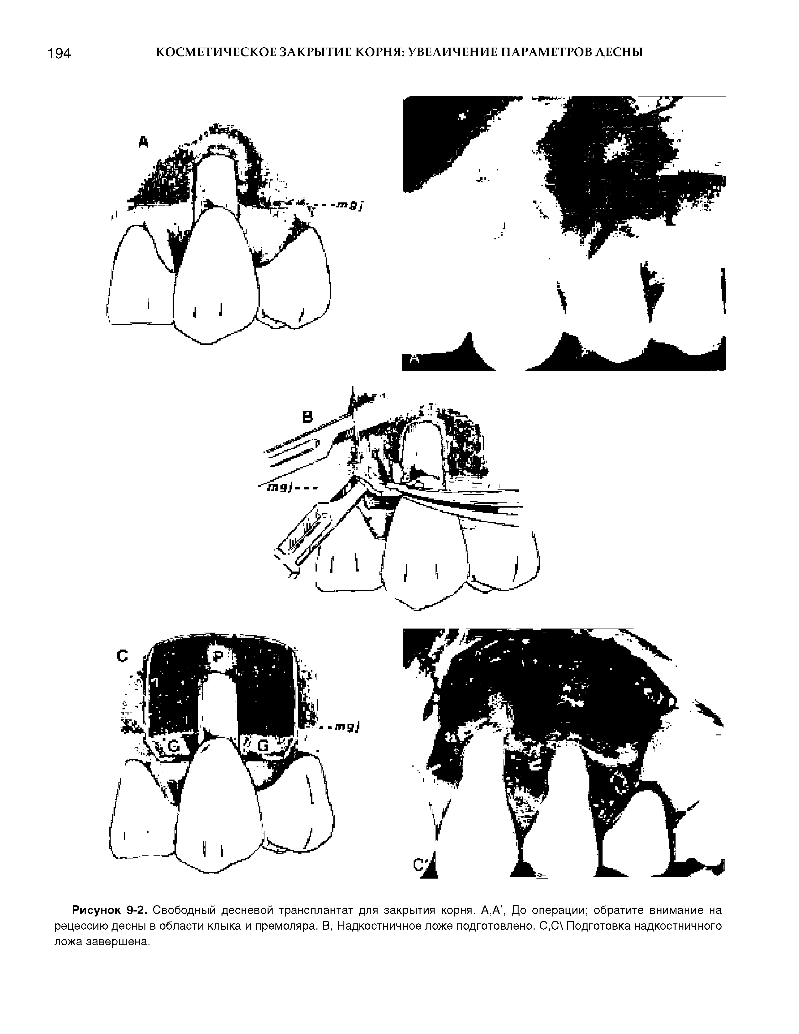 Рисунок 9-2. Свободный десневой трансплантат для закрытия корня. А,А, До операции обратите внимание на рецессию десны в области клыка и премоляра. В, Надкостничное ложе подготовлено. С,С Подготовка надкостничного ложа завершена.