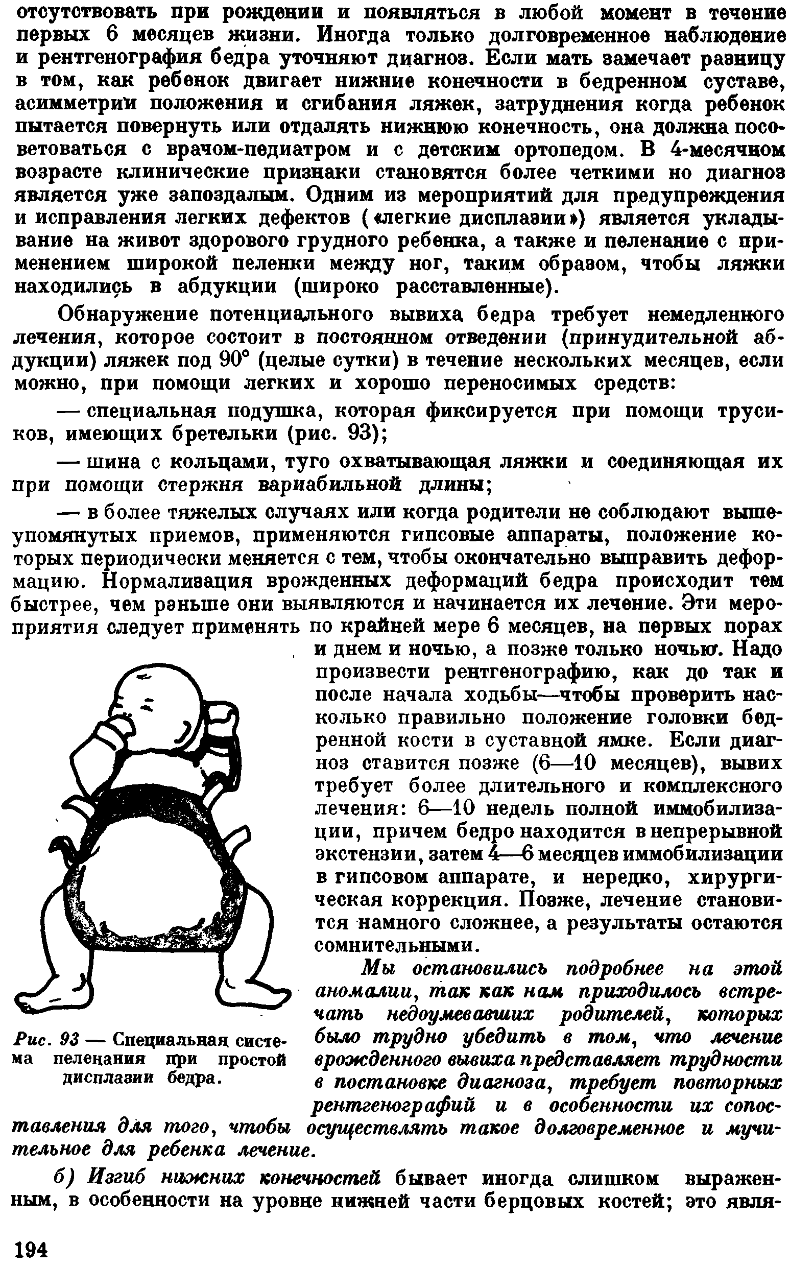 Рис. 93 — Специальная система пеленания при простой дисплазии бедра.