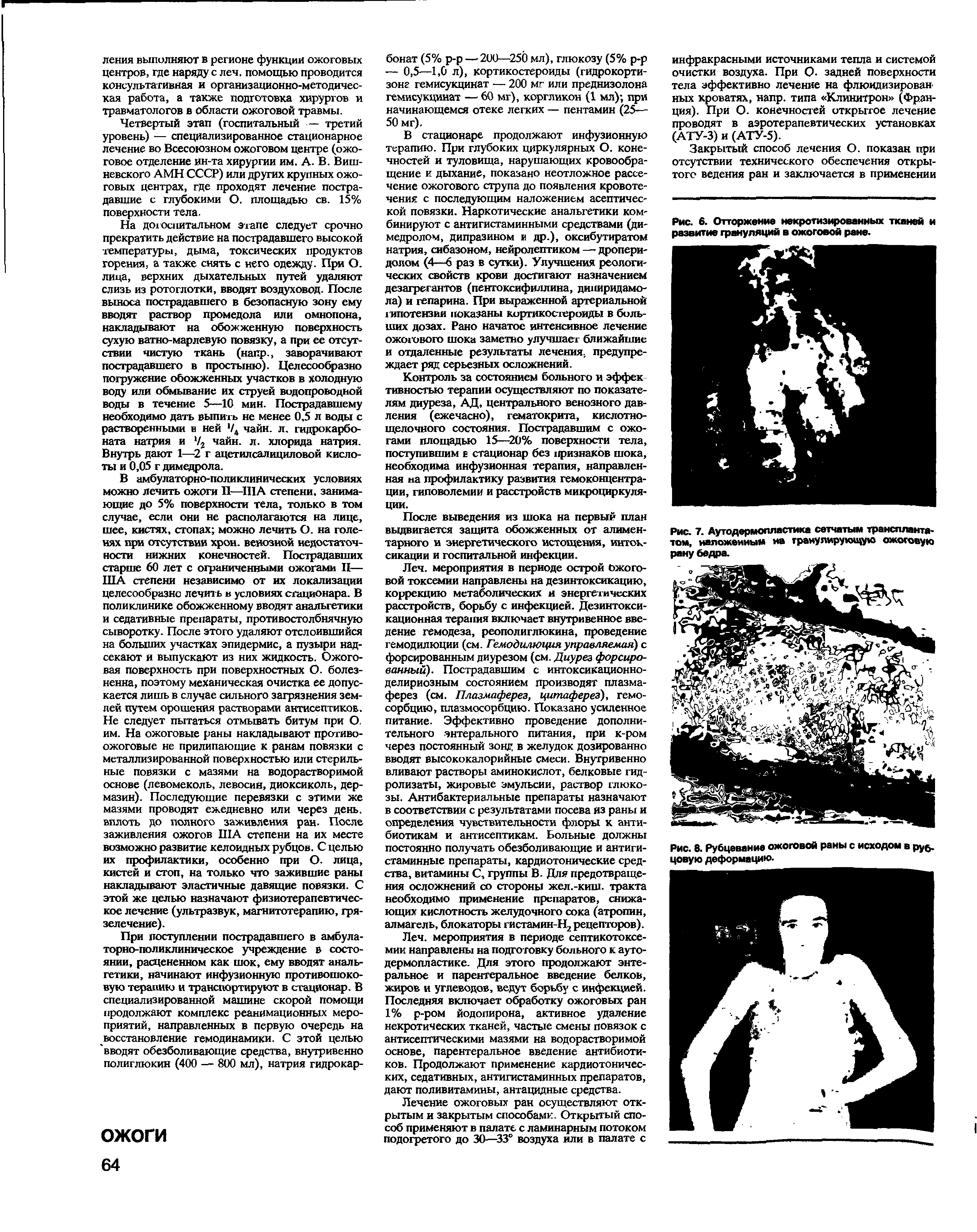 Рис. 7. Аутодермопластика сетчатым трансплантатом, наложенным на гранулирующую ожоговую рану бедра.