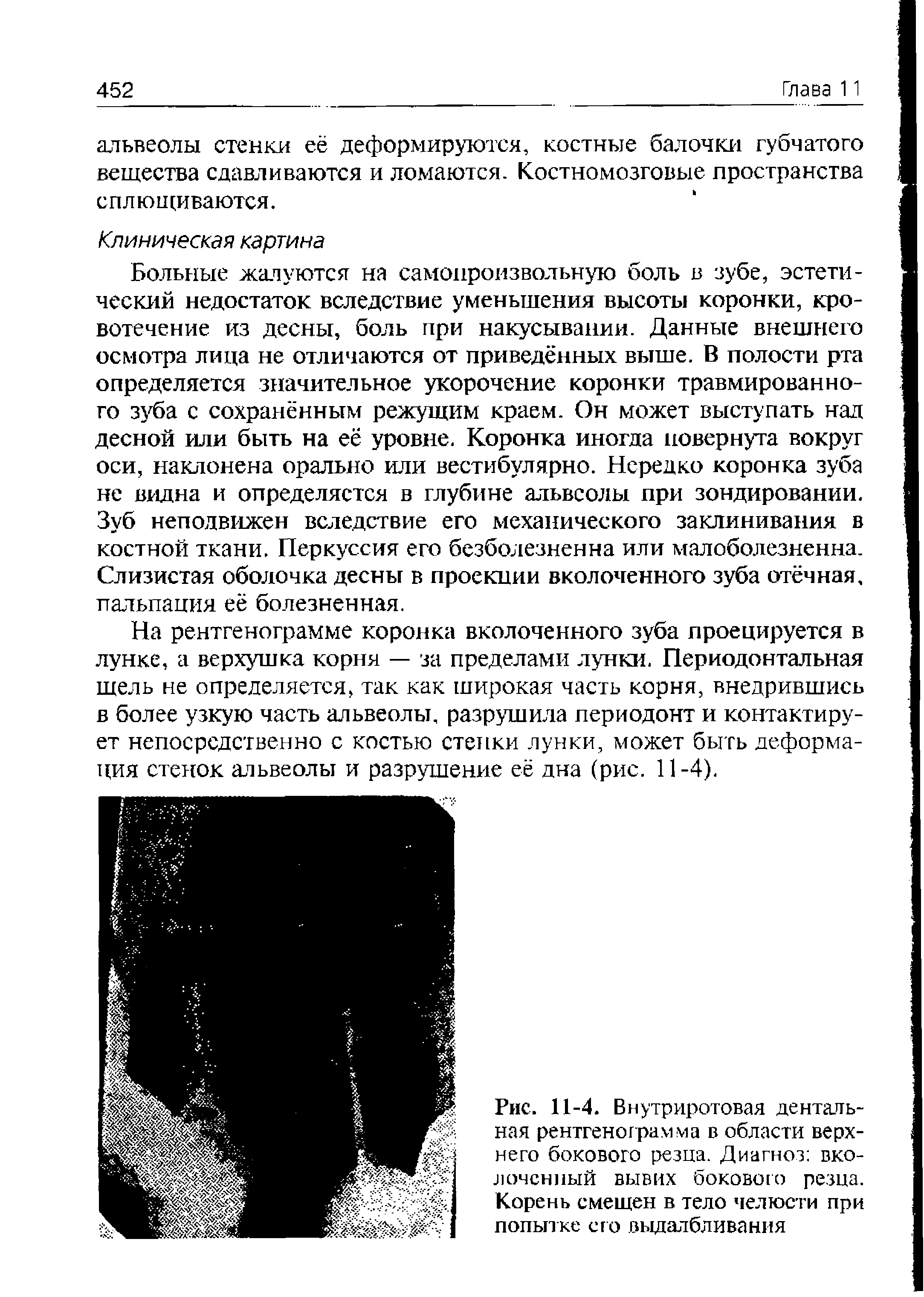 Рис. 11-4. Внутриротовая дентальная рентгенограмма в области верхнего бокового резца. Диагноз вколоченный вывих бокового резца. Корень смещен в тело челюсти при попытке его выдалбливания...