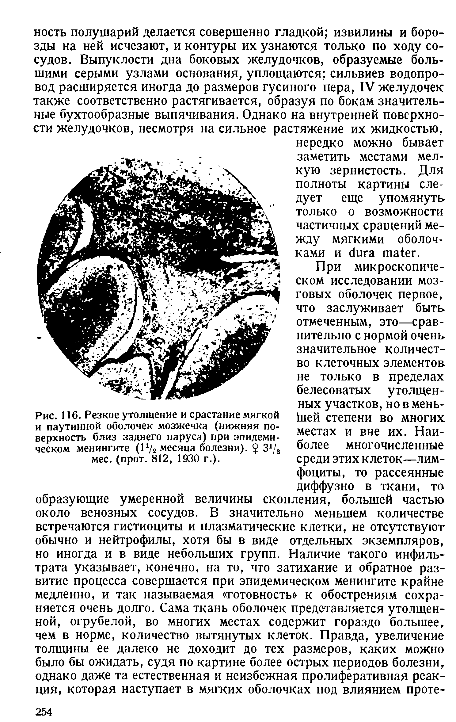 Рис. 116. Резкое утолщение и срастание мягкой и паутинной оболочек мозжечка (нижняя поверхность близ заднего паруса) при эпидемическом менингите (Р/г месяца болезни). 3 /2 мес. (прот. 812, 1930 г.).