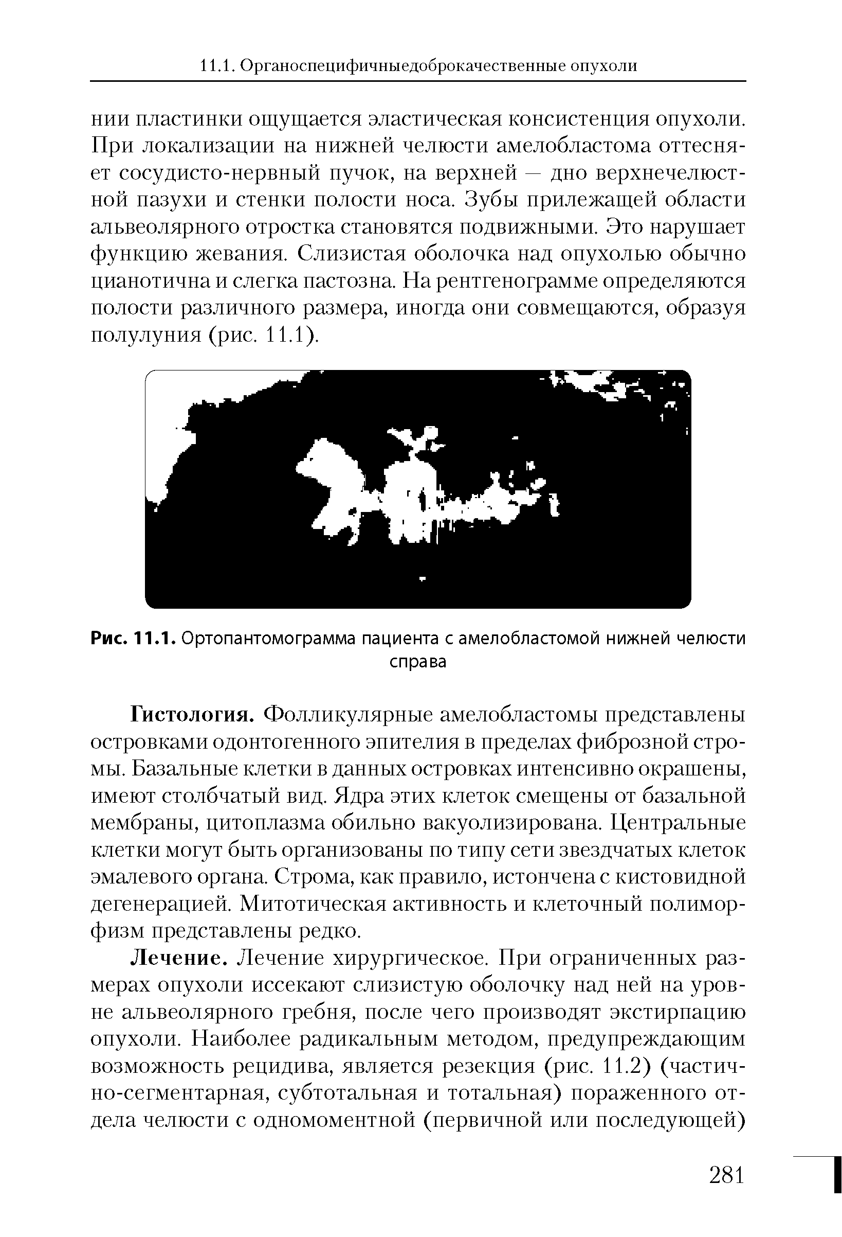 Рис. 11.1. Ортопантомограмма пациента с амелобластомой нижней челюсти спра ва...